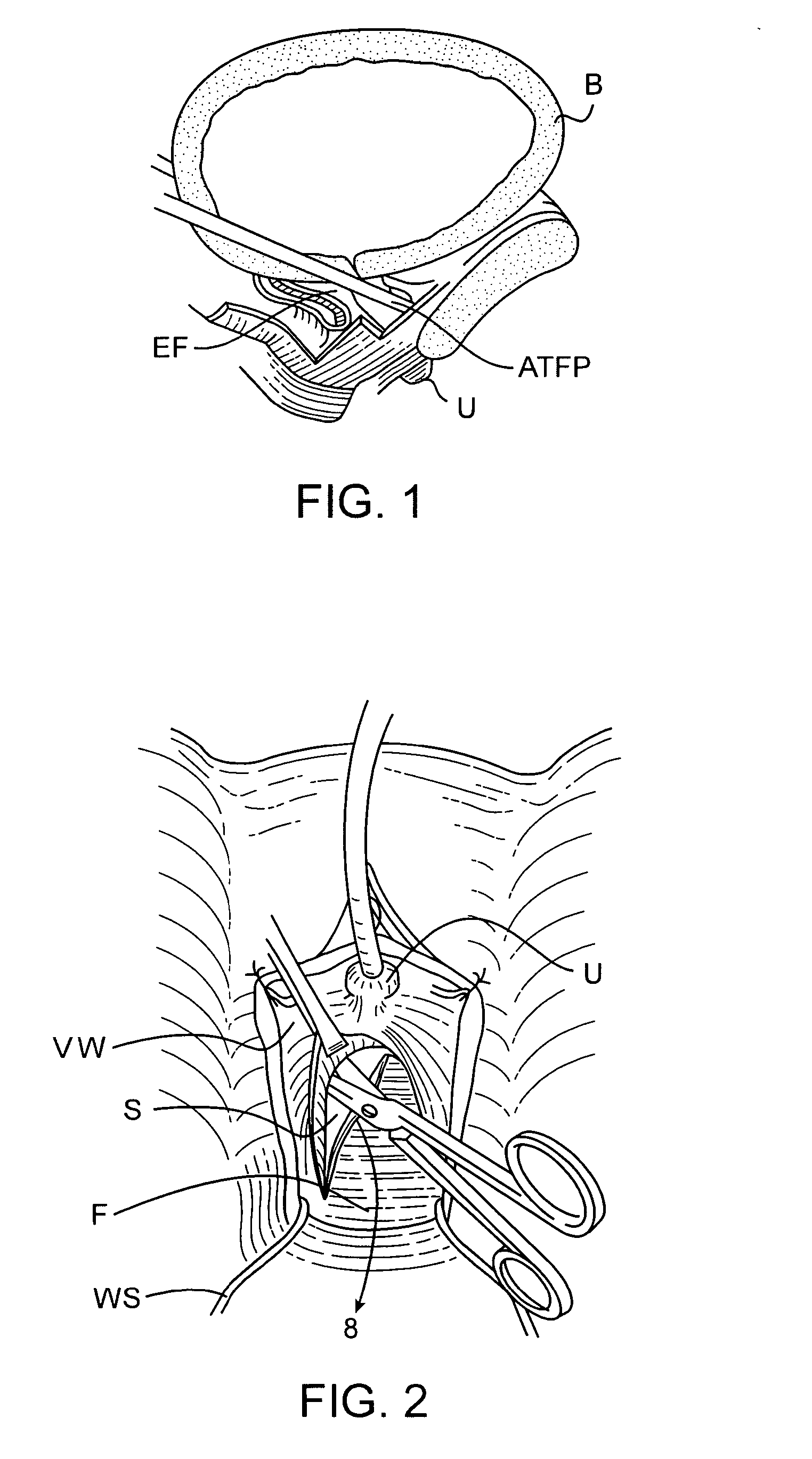 Non-surgical incontinence treatment system and method
