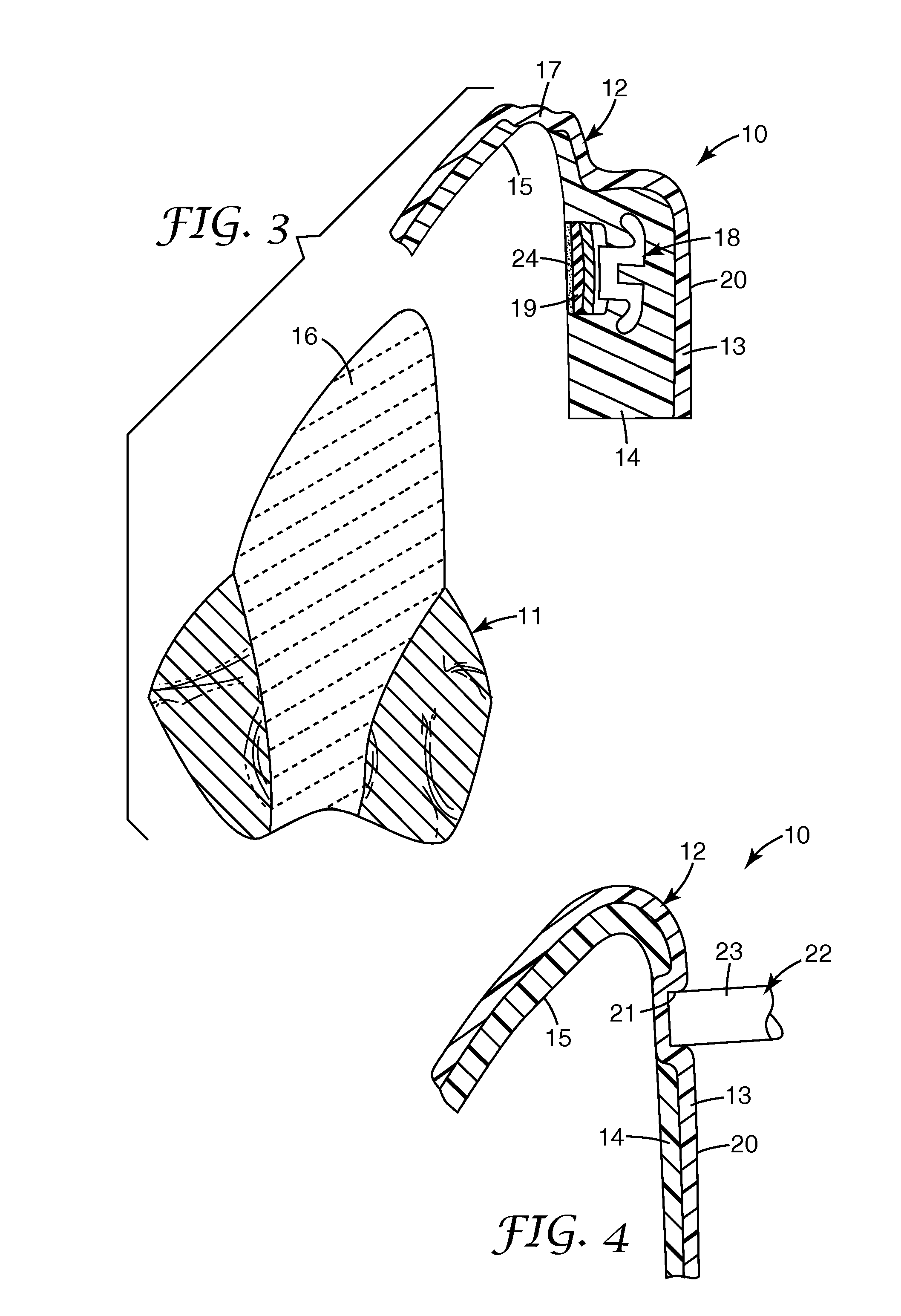 Methods and apparatus for bonding orthodontic appliances using photocurable adhesive material