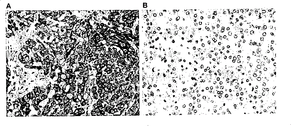 The use of granulin-epithelin precursor (GEP) antibodies for detection and suppression of hepatocellular carcinoma (HCC)