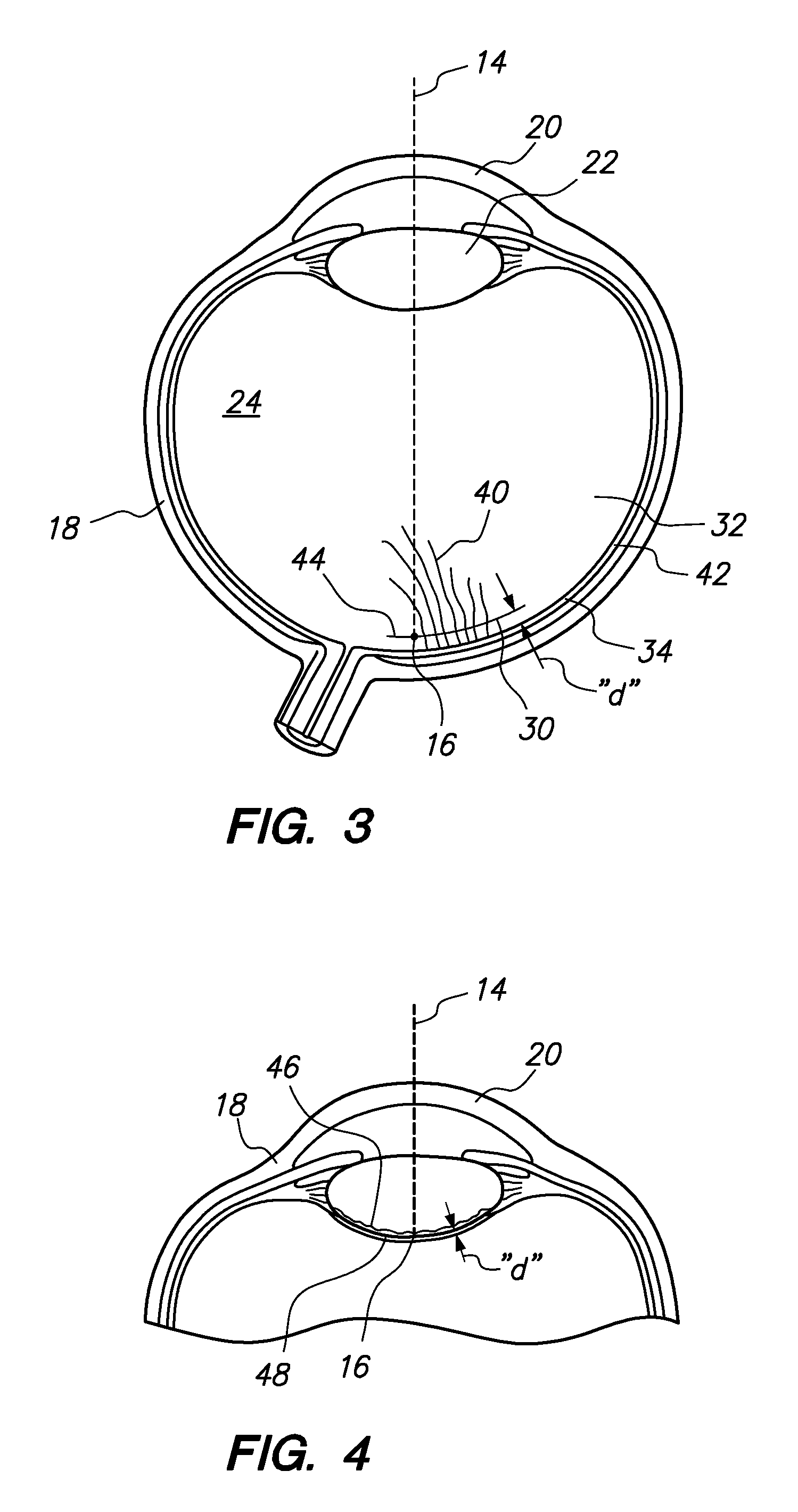 System and Method for Laser Ablation on a Surgical Surface
