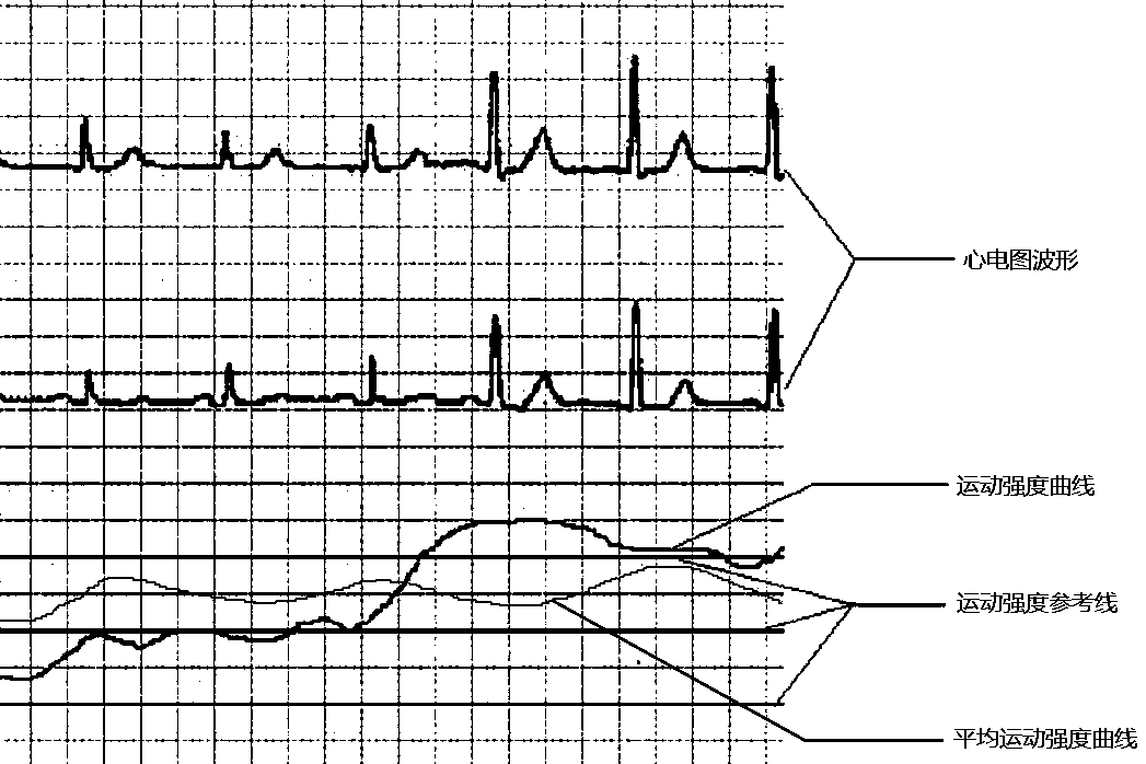 Portable electrocardiogram (ECG) machine with motion monitoring function