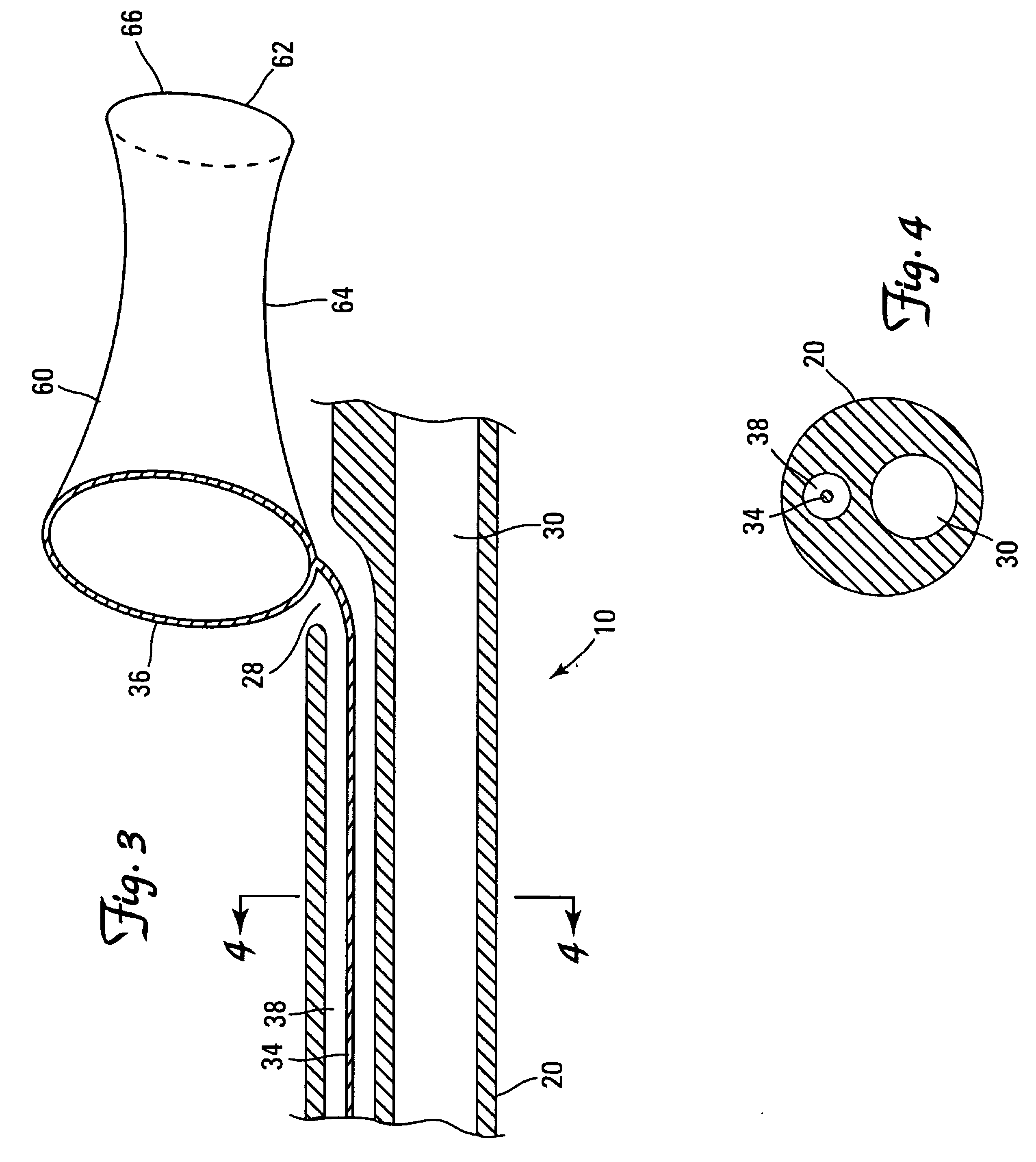 Local perfusion device