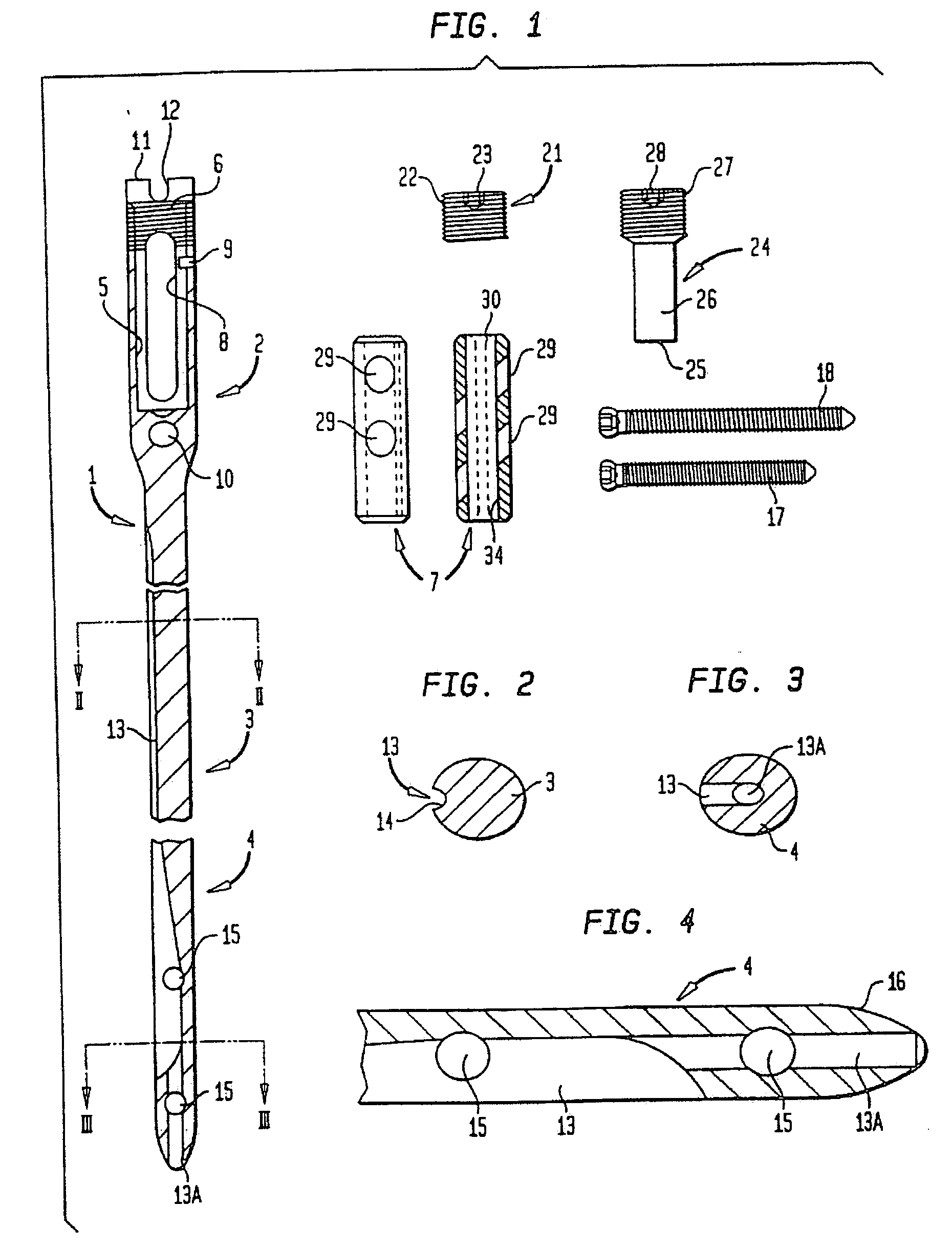 Modular intramedullary nail