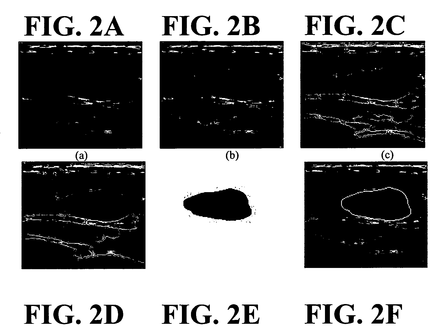 Segmentation of lesions in ultrasound images