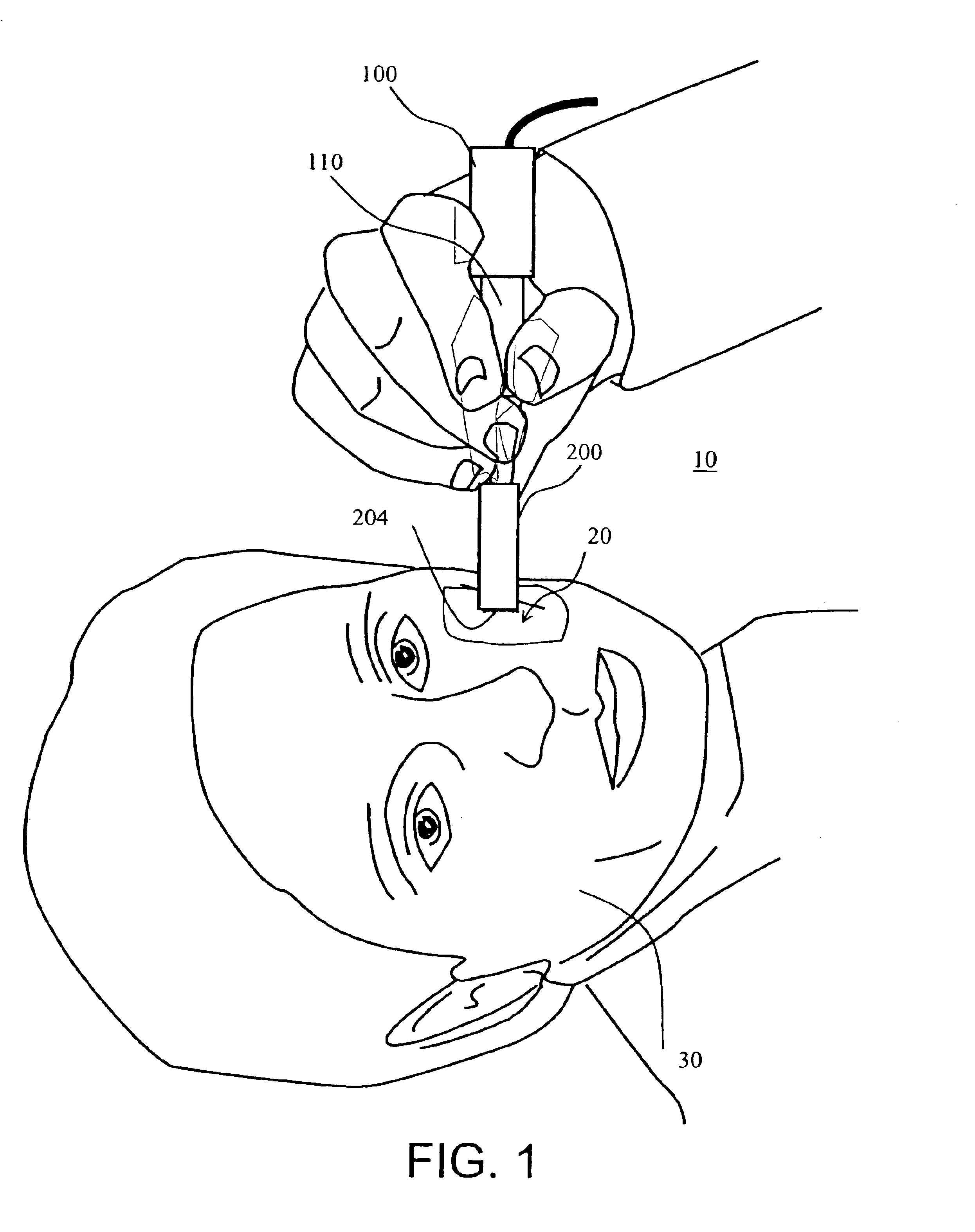Method and apparatus for in-vivo transdermal and/or intradermal delivery of drugs by sonoporation