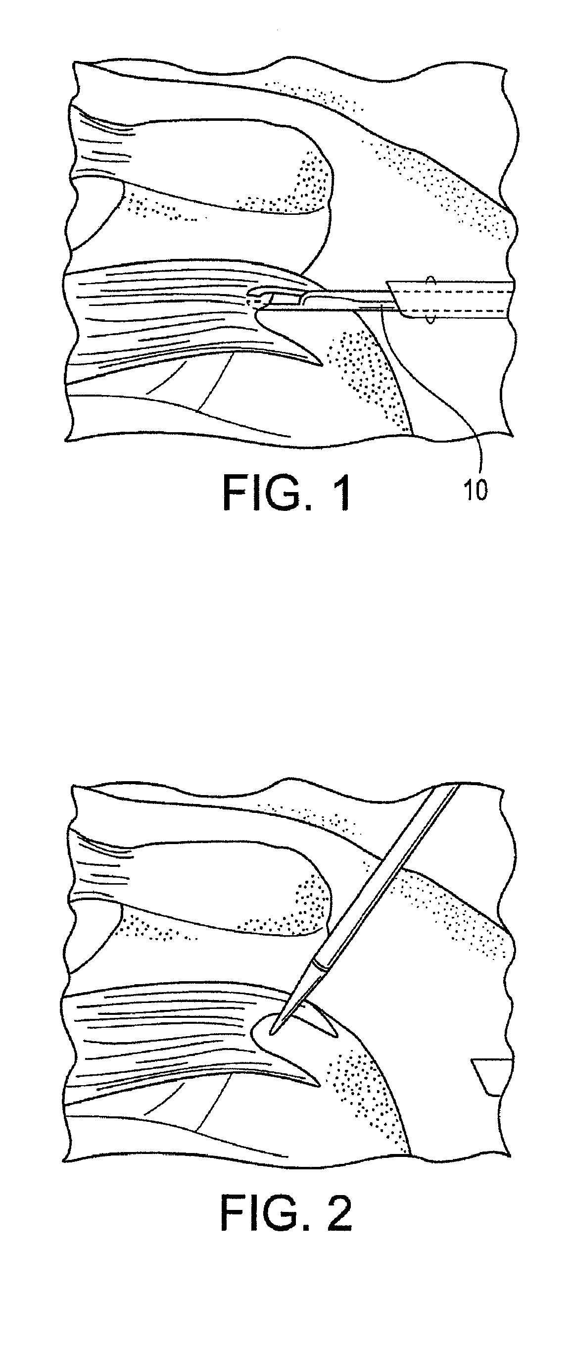 Fenestrated swivel anchor for knotless fixation of tissue