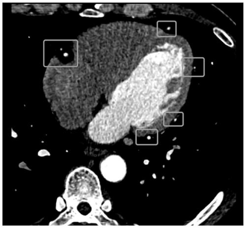 A kind of human heart coronary artery extraction method