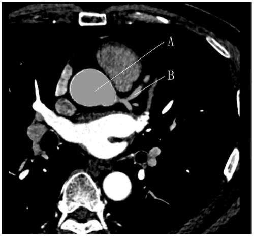 A kind of human heart coronary artery extraction method