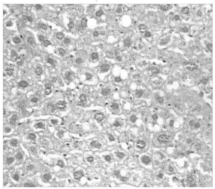 Method for establishing mouse model with hepatic preneoplastic lesion caused by double factors of alcohol and HBV