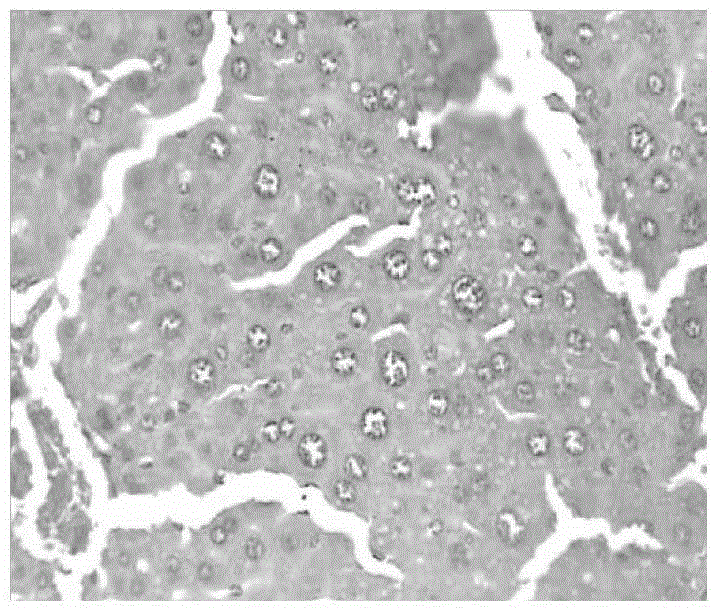 Method for establishing mouse model with hepatic preneoplastic lesion caused by double factors of alcohol and HBV