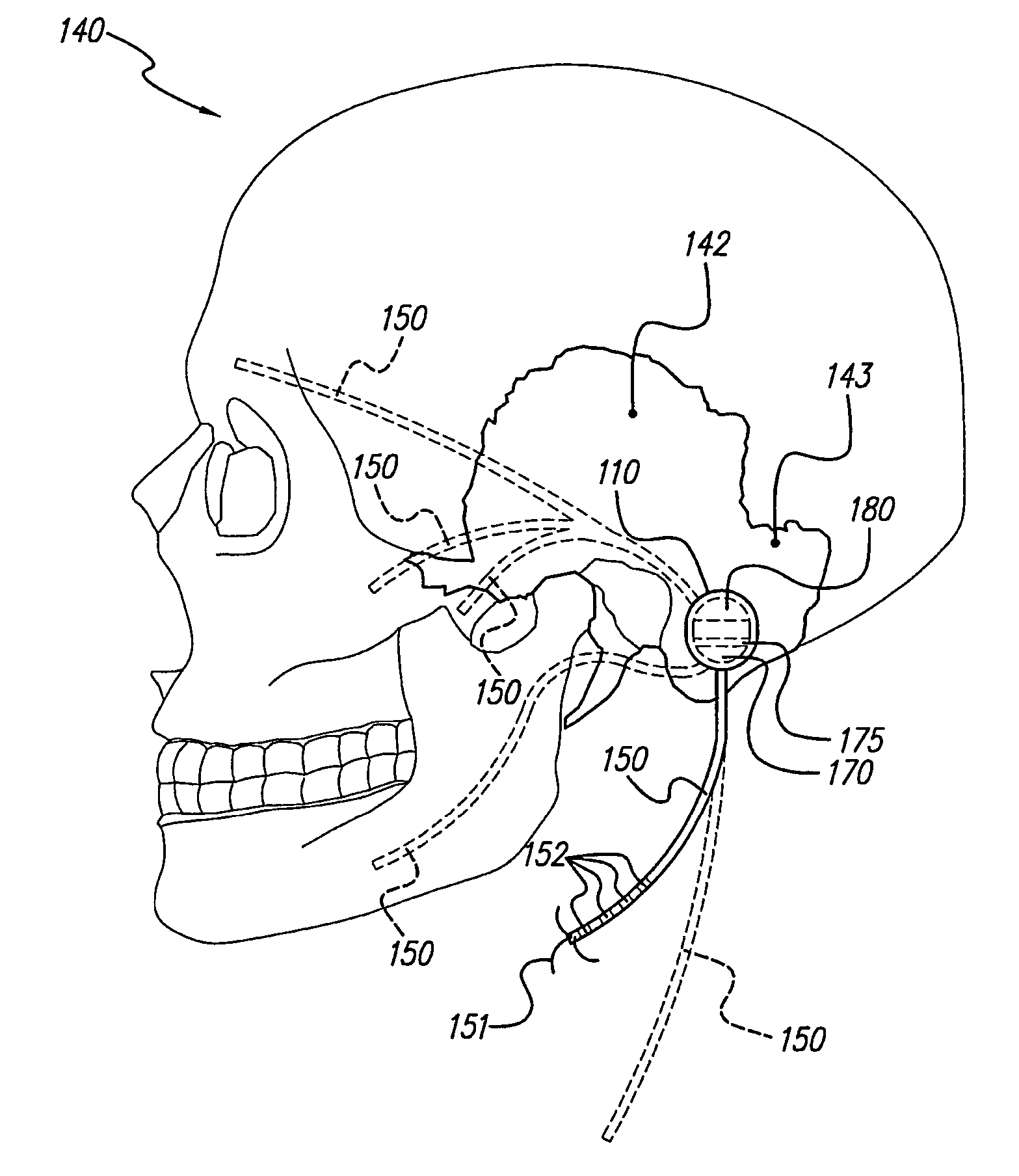 Skull-mounted electrical stimulation system and method for treating patients