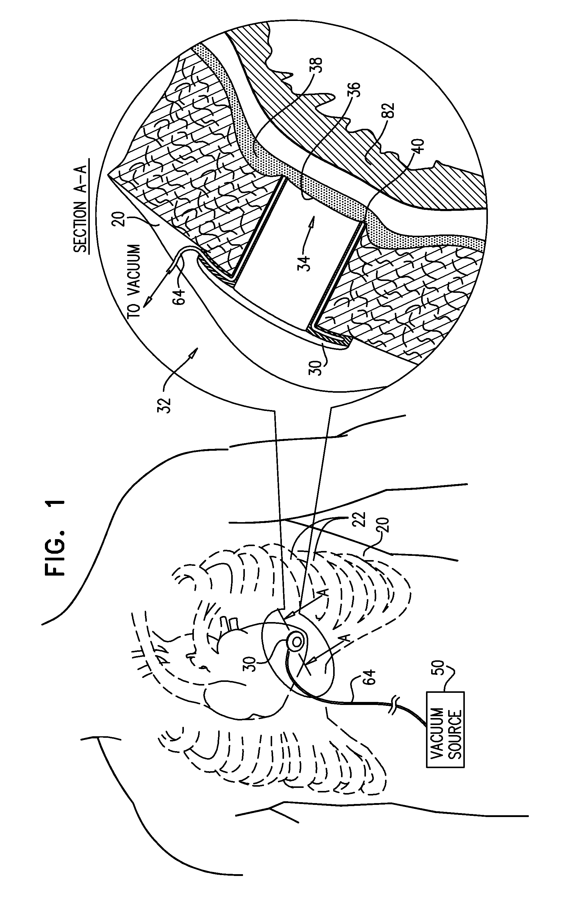 Surgical techniques and closure devices for direct cardiac catheterization