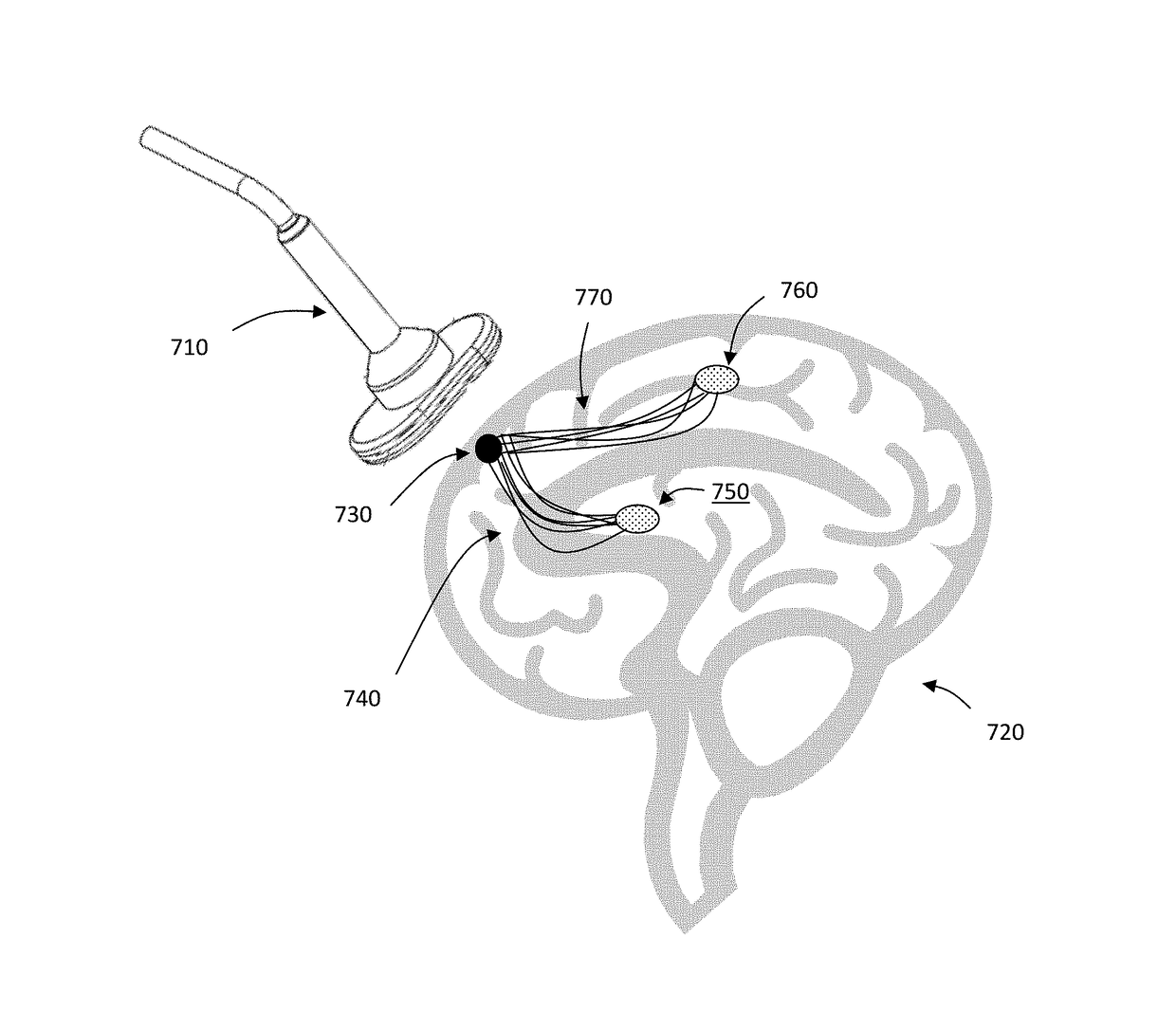 Method and system for combining anatomical connectivity patterns and navigated brain stimulation