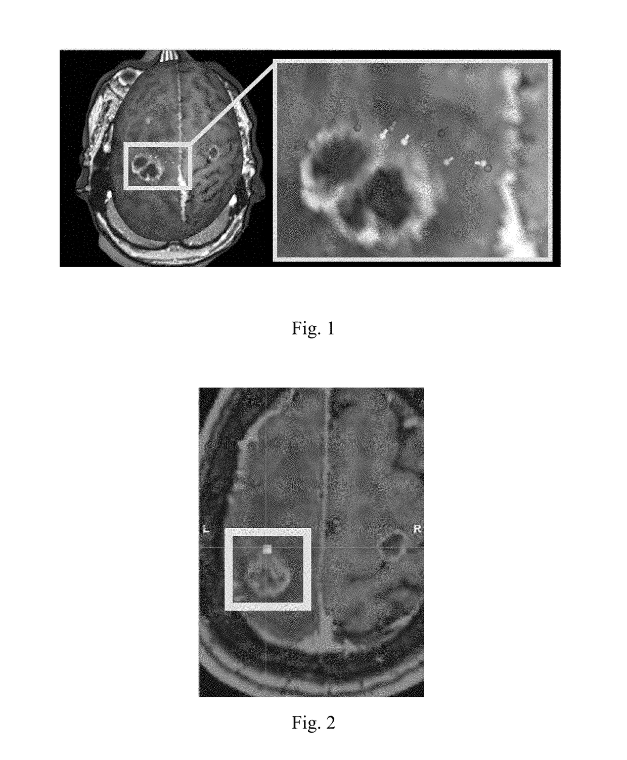 Method and system for combining anatomical connectivity patterns and navigated brain stimulation