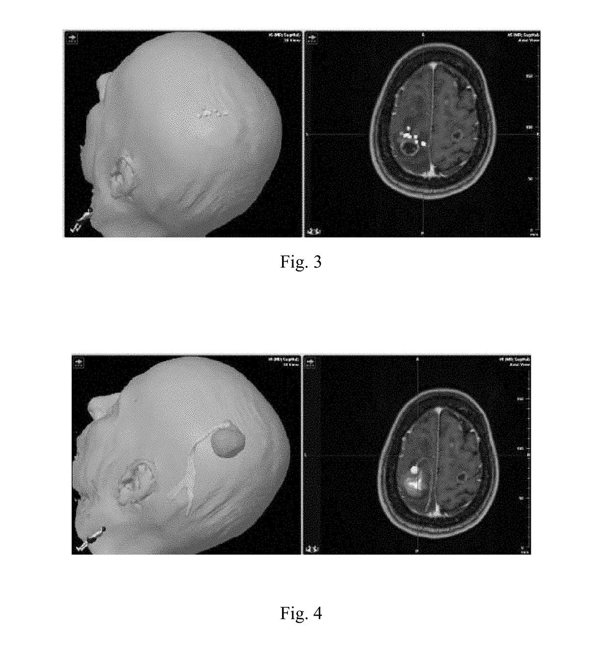 Method and system for combining anatomical connectivity patterns and navigated brain stimulation