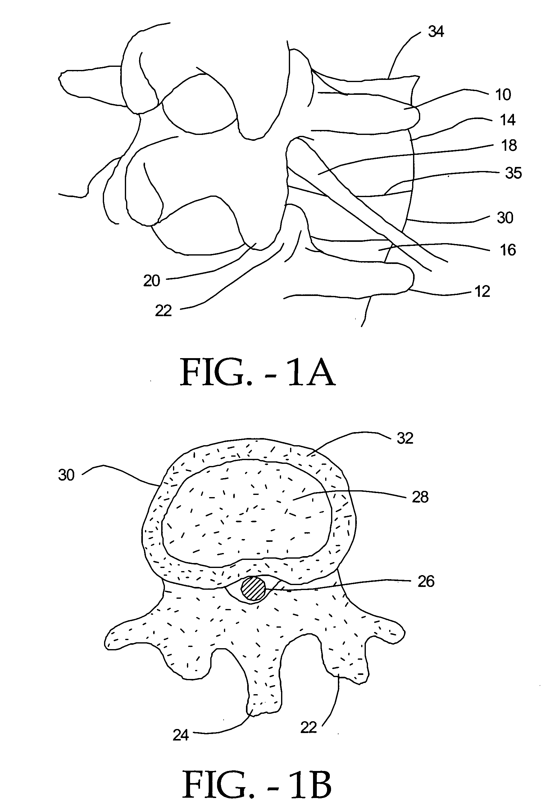 Posterior approach implant method for assembly of multi-piece artificial spinal disk replacement device in situ