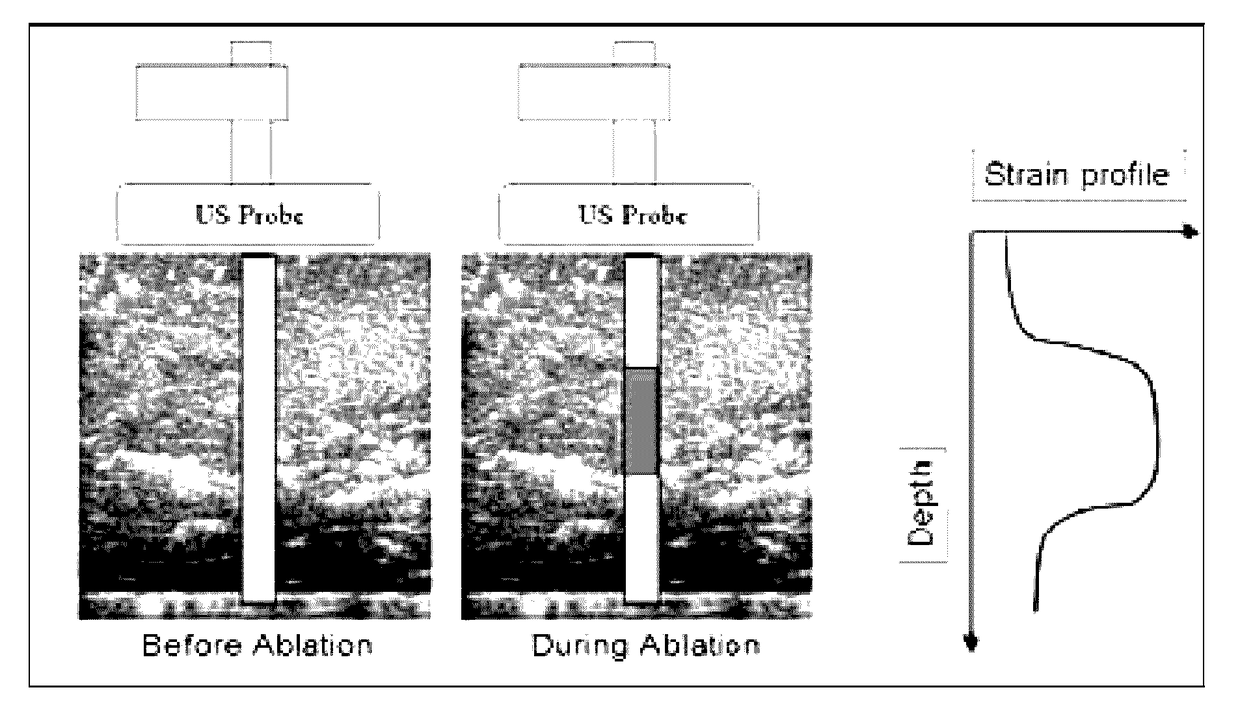 Real time three-dimensional heat-induced echo-strain imaging for monitoring high-intensity acoustic ablation produced by conformal interstitial and external directional ultrasound therapy applicators
