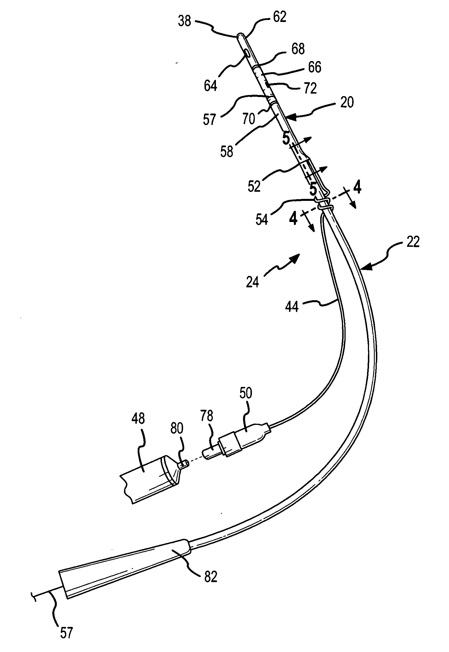 Partial-length indwelling urinary catheter and method permitting selective urine discharge