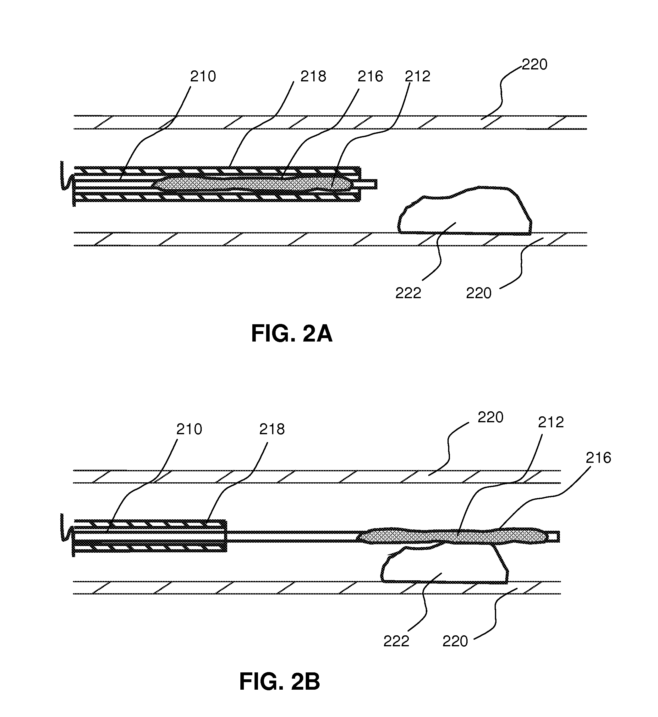 Local delivery of water-soluble or water-insoluble therapeutic agents to the surface of body lumens