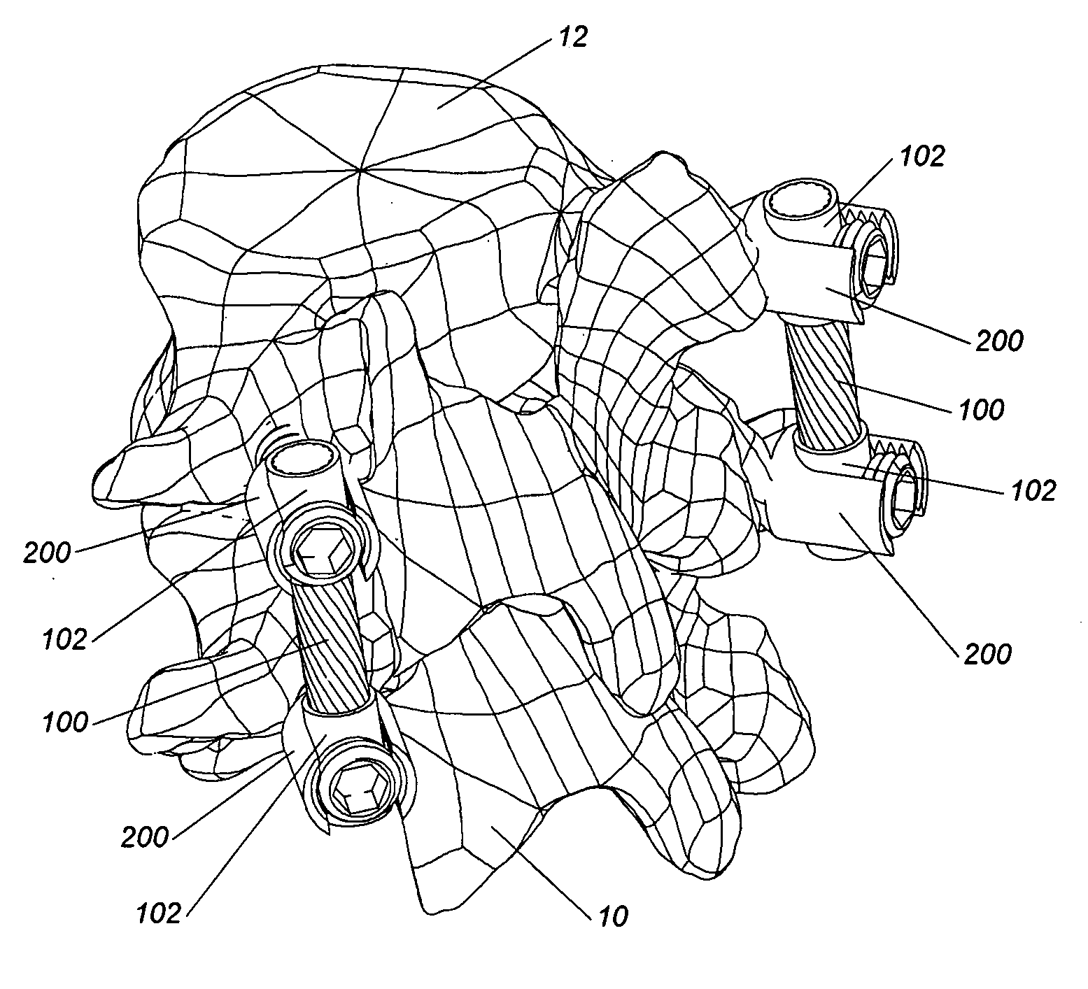 Dynamic spinal stabilization system incorporating a wire rope