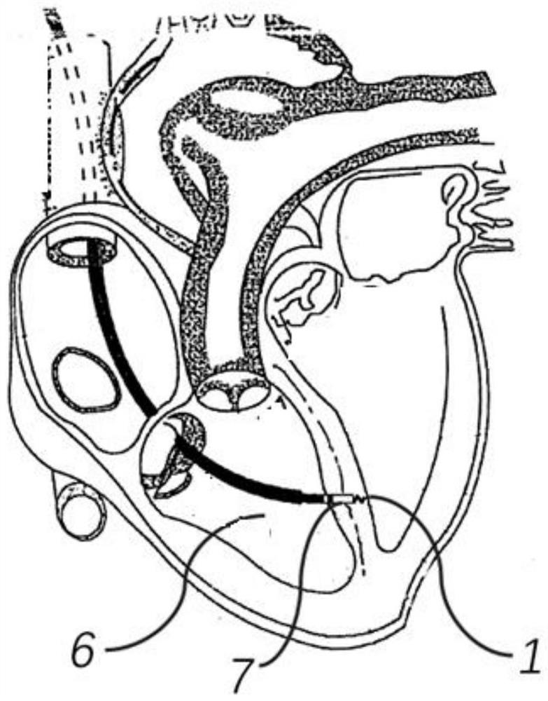 Ablation electrode assembly and ablation catheter