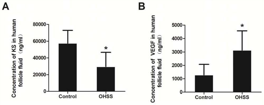 Diagnosis marker kallistatin for ovarian hyperstimulation syndrome and its application