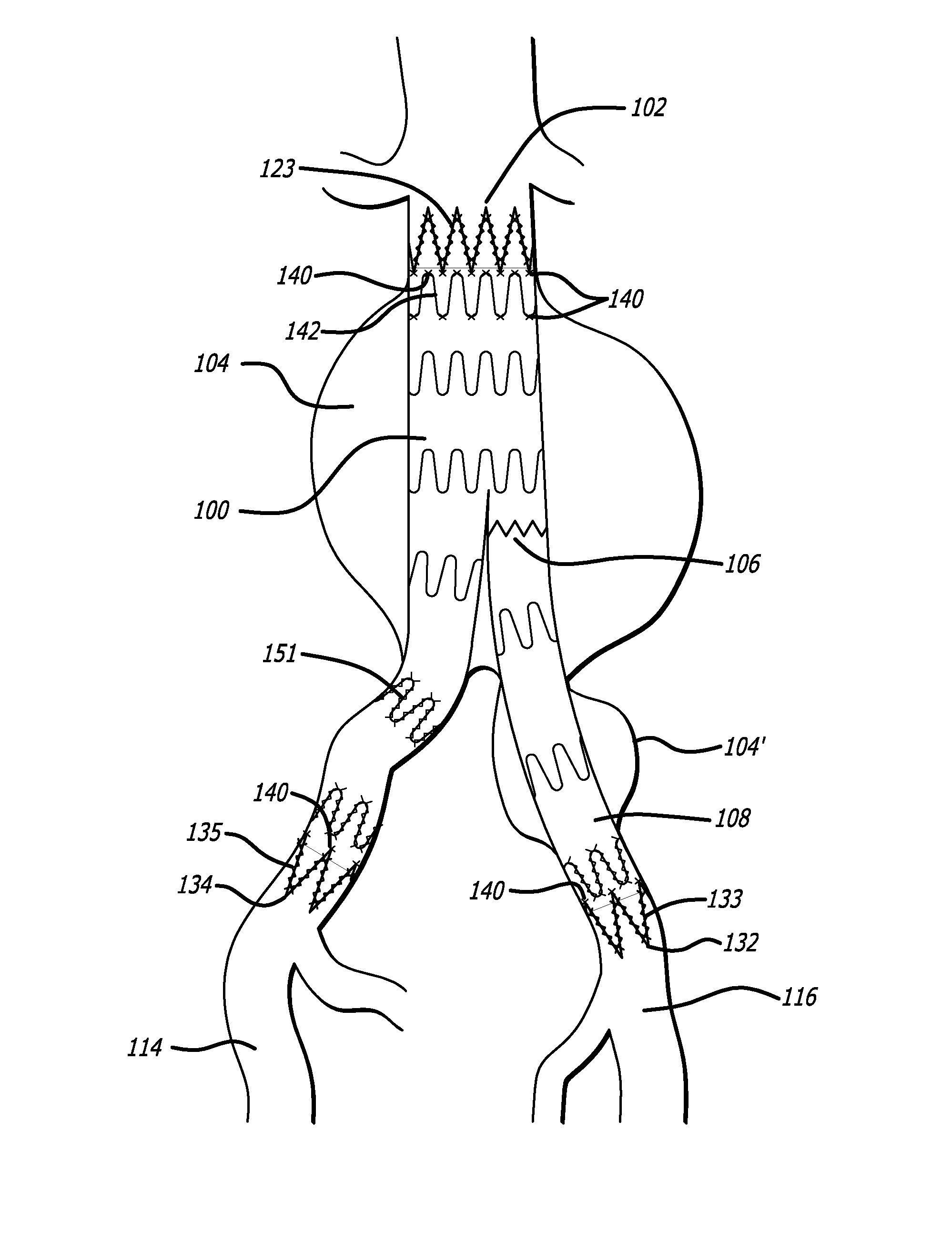 Methods and Devices for Contributing to Improved Stent Graft Fixation