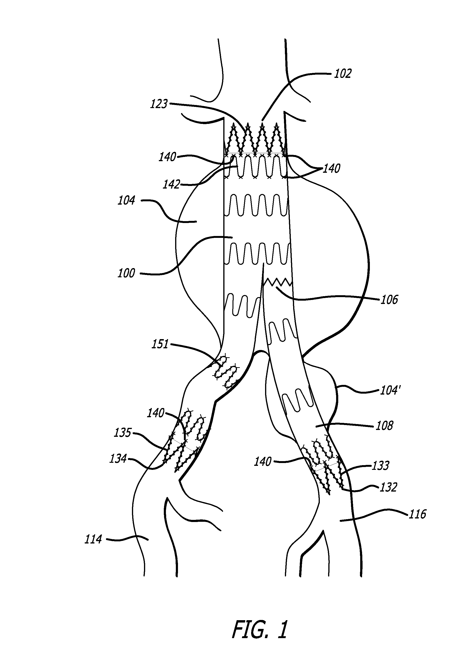 Methods and Devices for Contributing to Improved Stent Graft Fixation