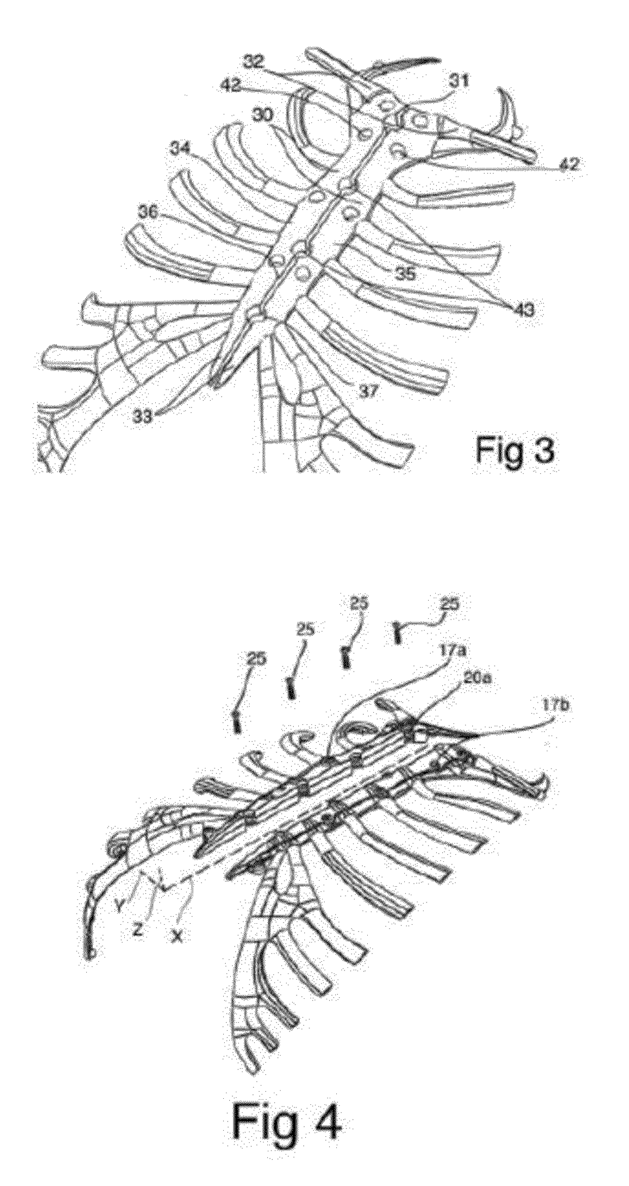 Split sternum prosthesis