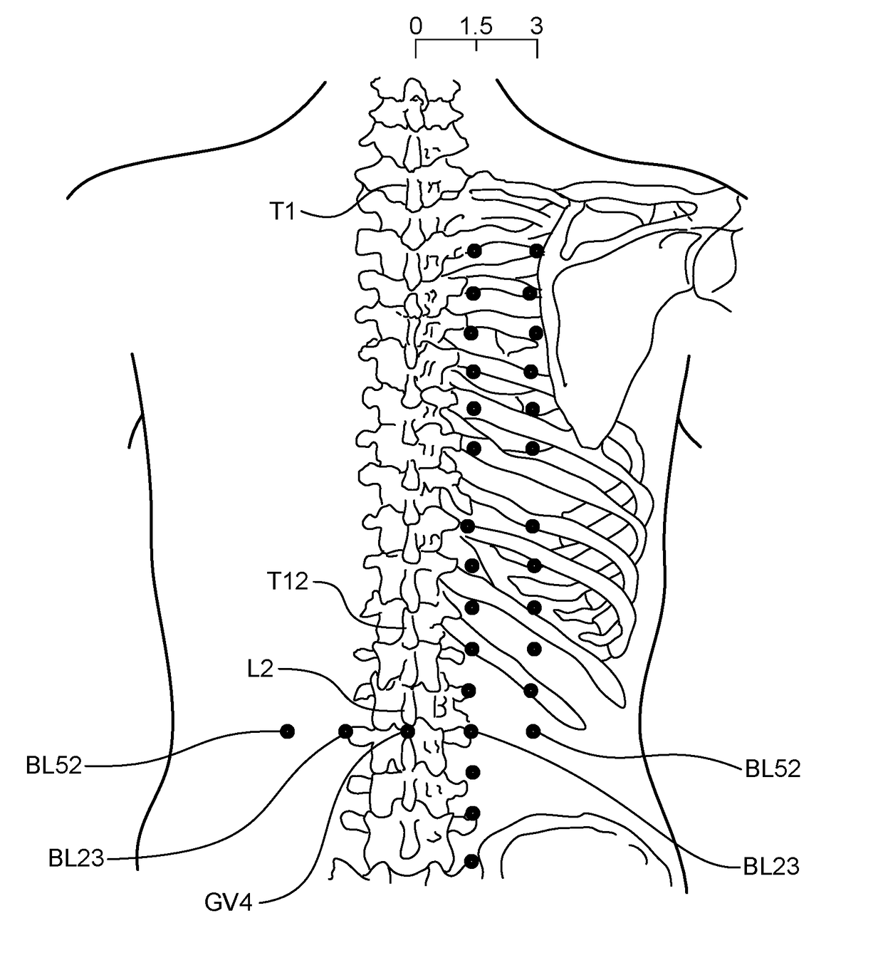 Methods and Systems for Treating a Chronic Low Back Pain Condition Using an Implantable Electroacupuncture Device