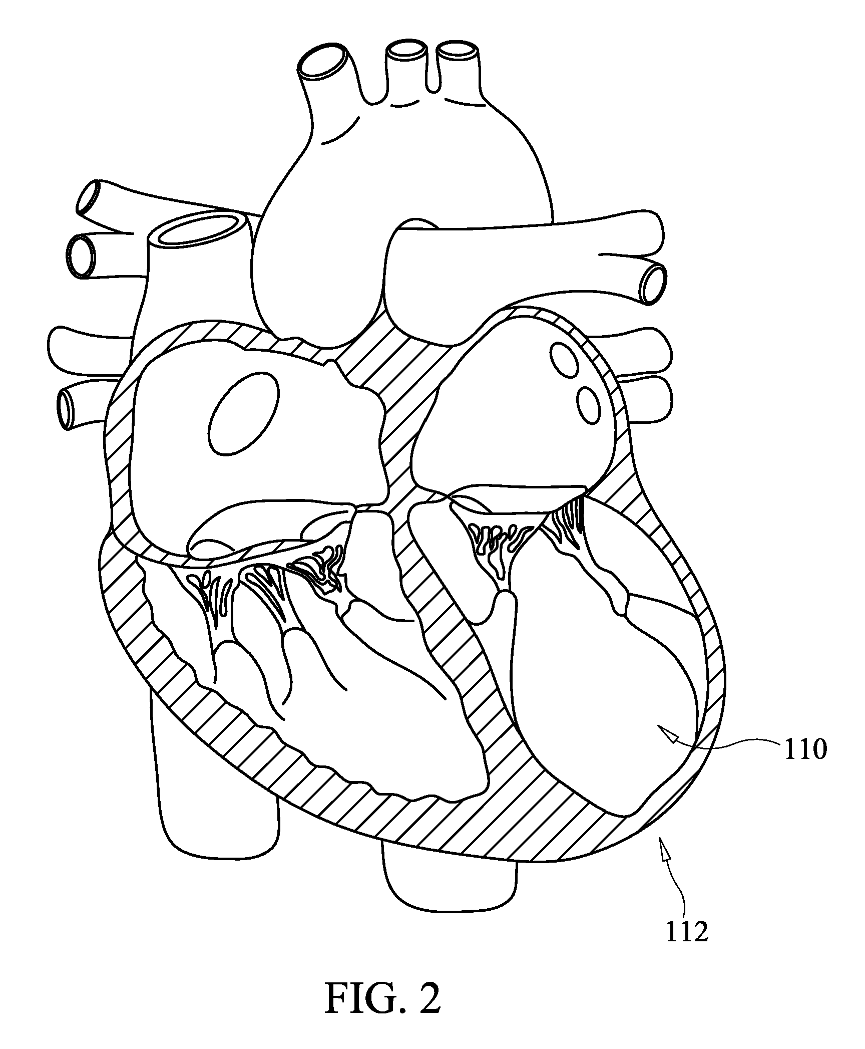 Apical Papillary Msucle Attachment for Left Ventricular Reduction