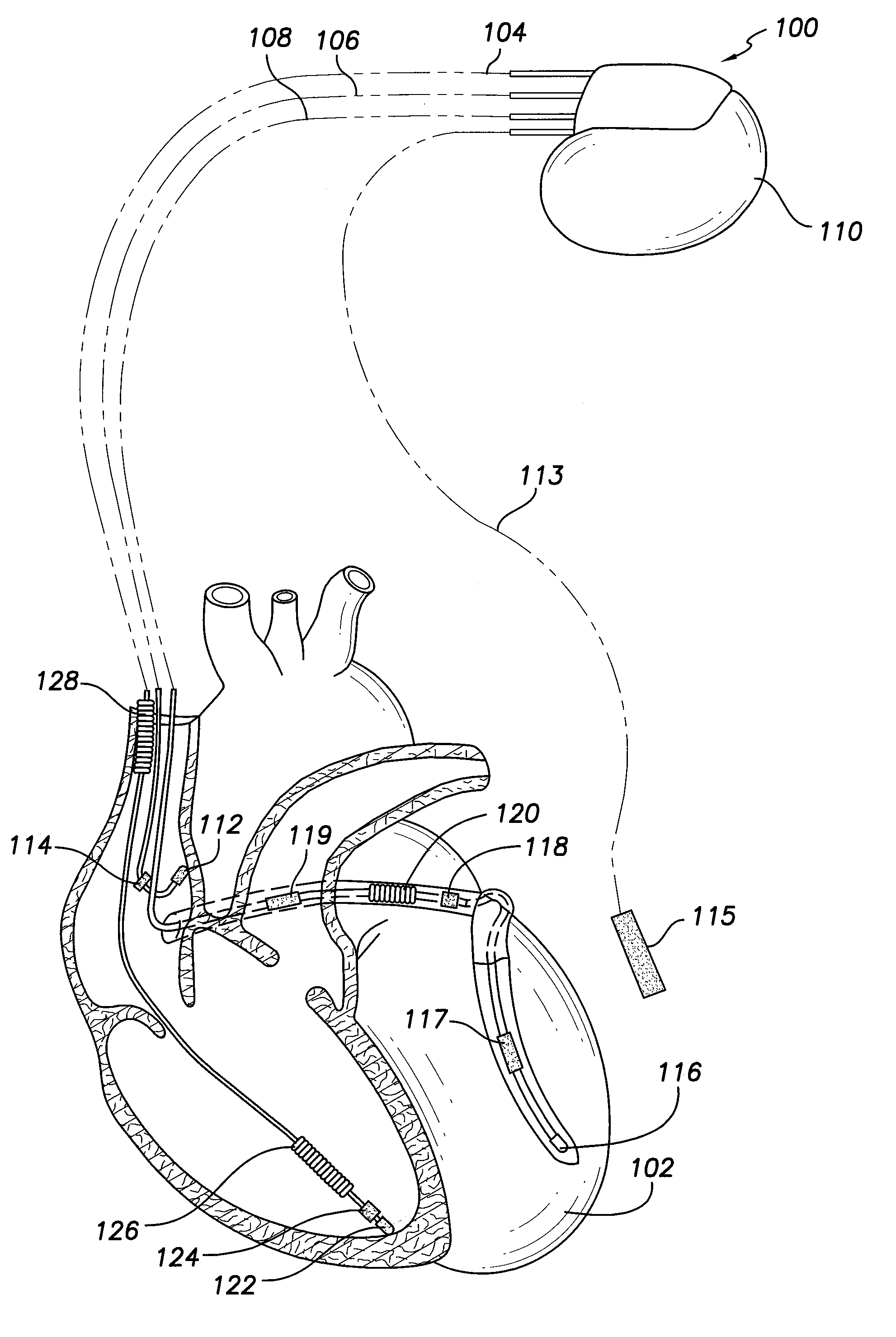 Method and system for identifying a potential lead failure in an implantable medical device