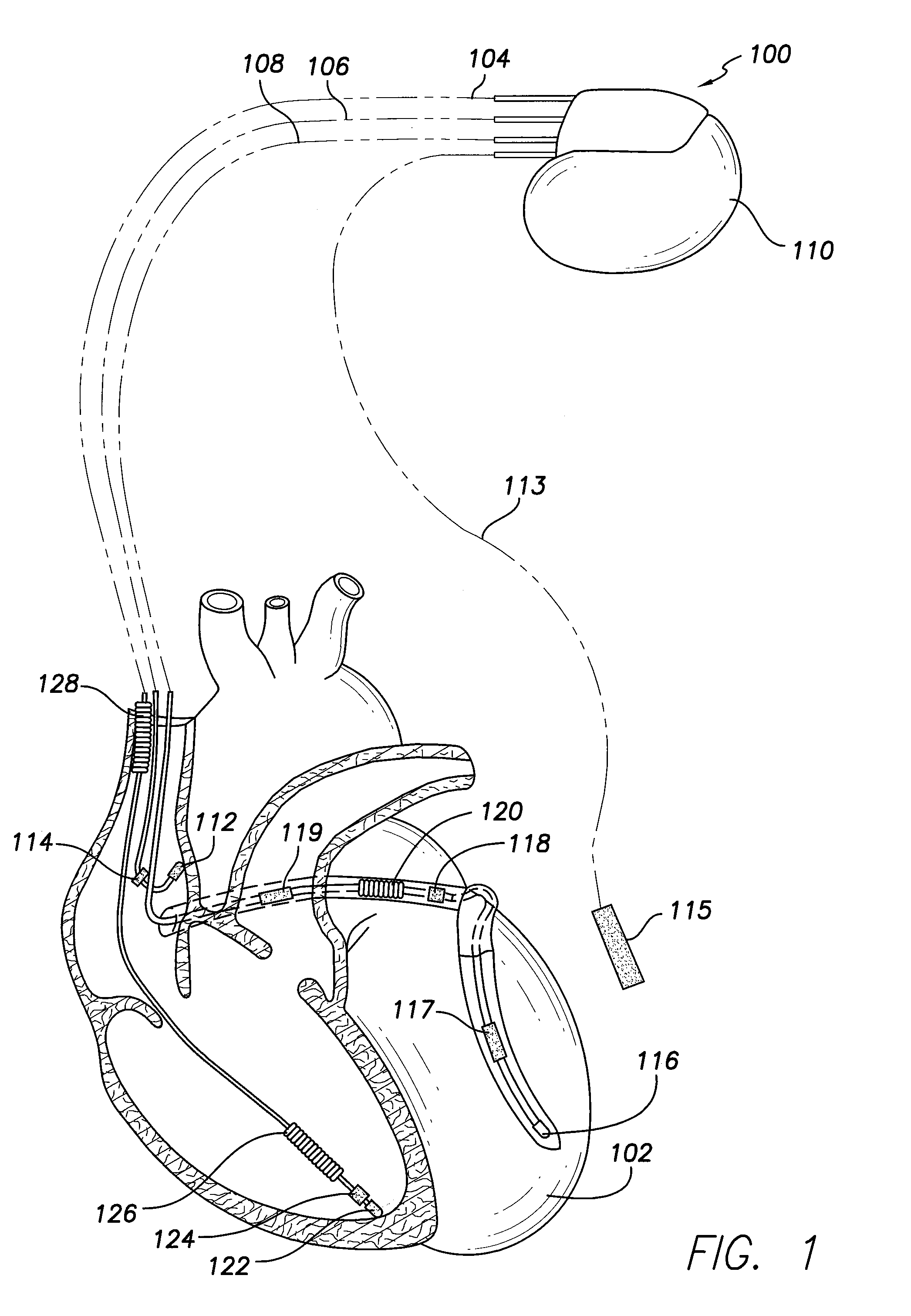 Method and system for identifying a potential lead failure in an implantable medical device