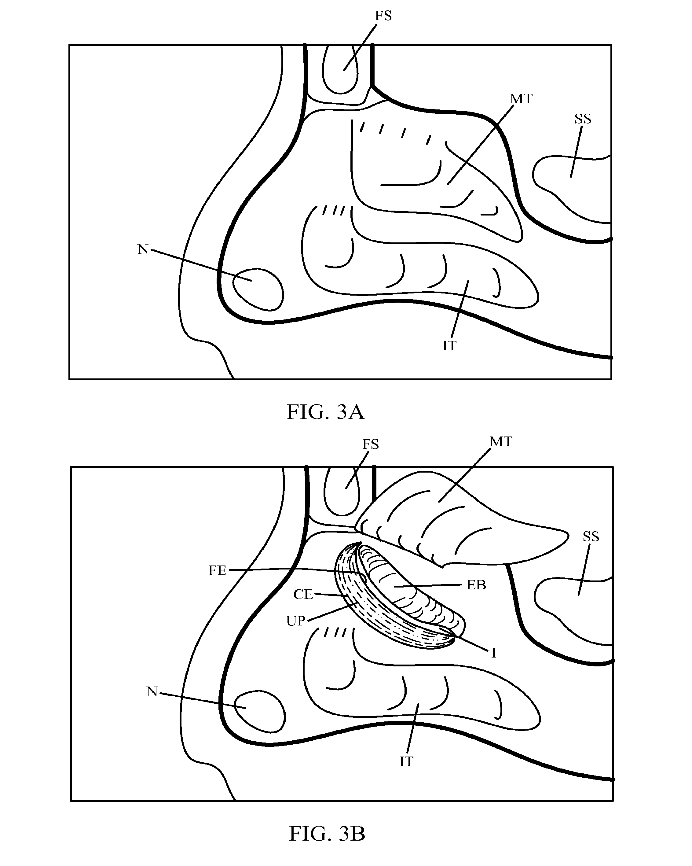 Guide catheter and method of use