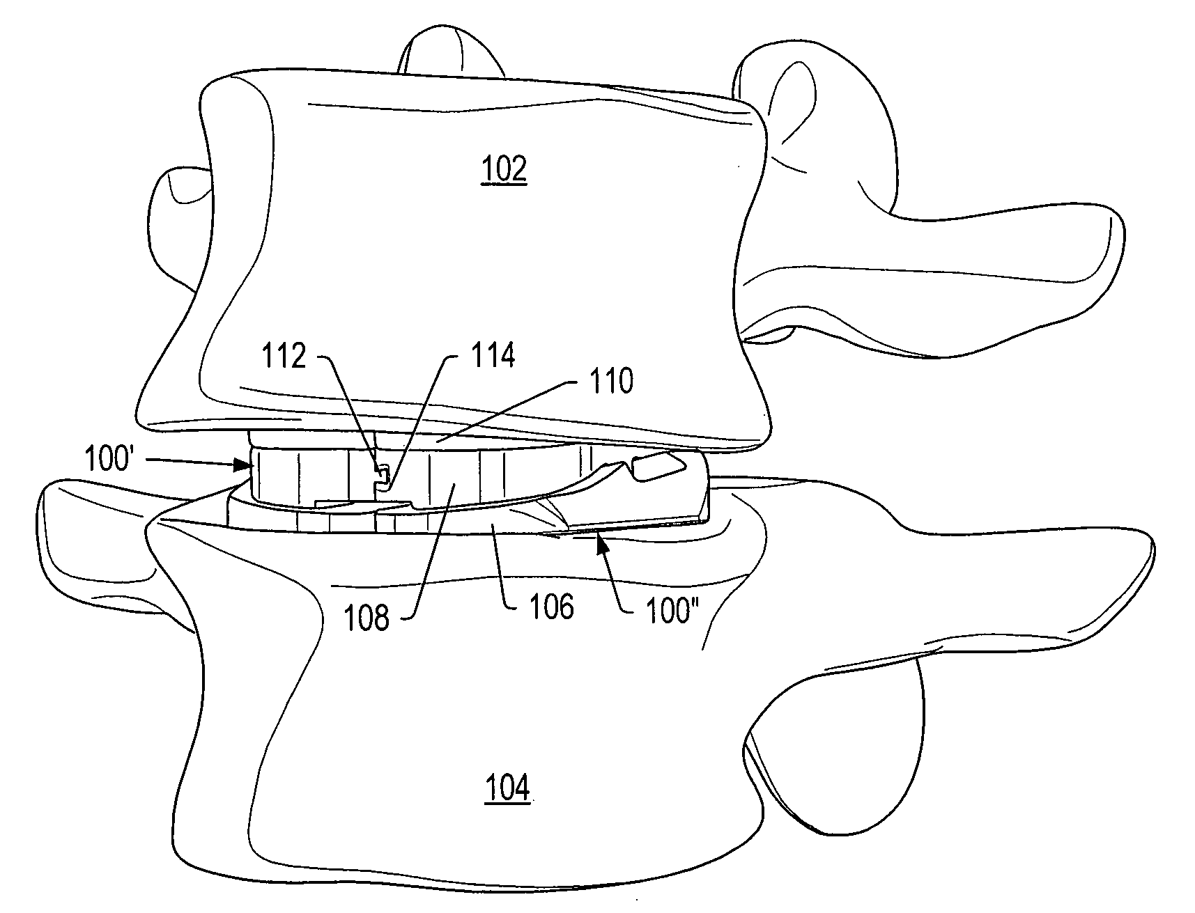 Dampener system for a posterior stabilization system with a variable length elongated member