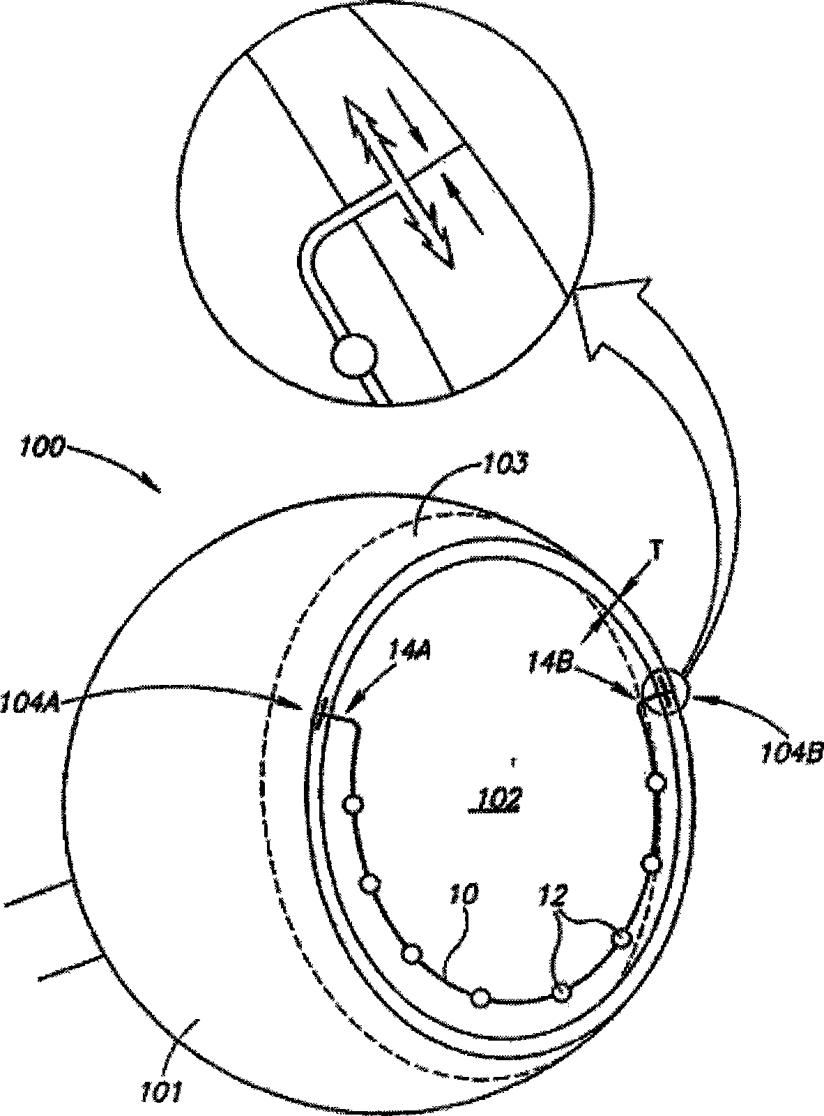 Intraocular drug dispenser