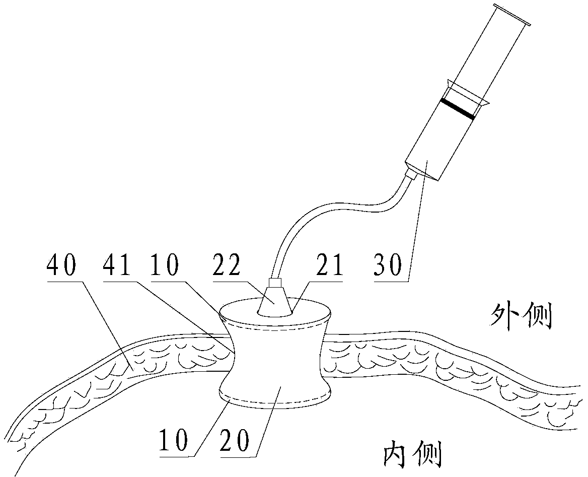 Wound closing device