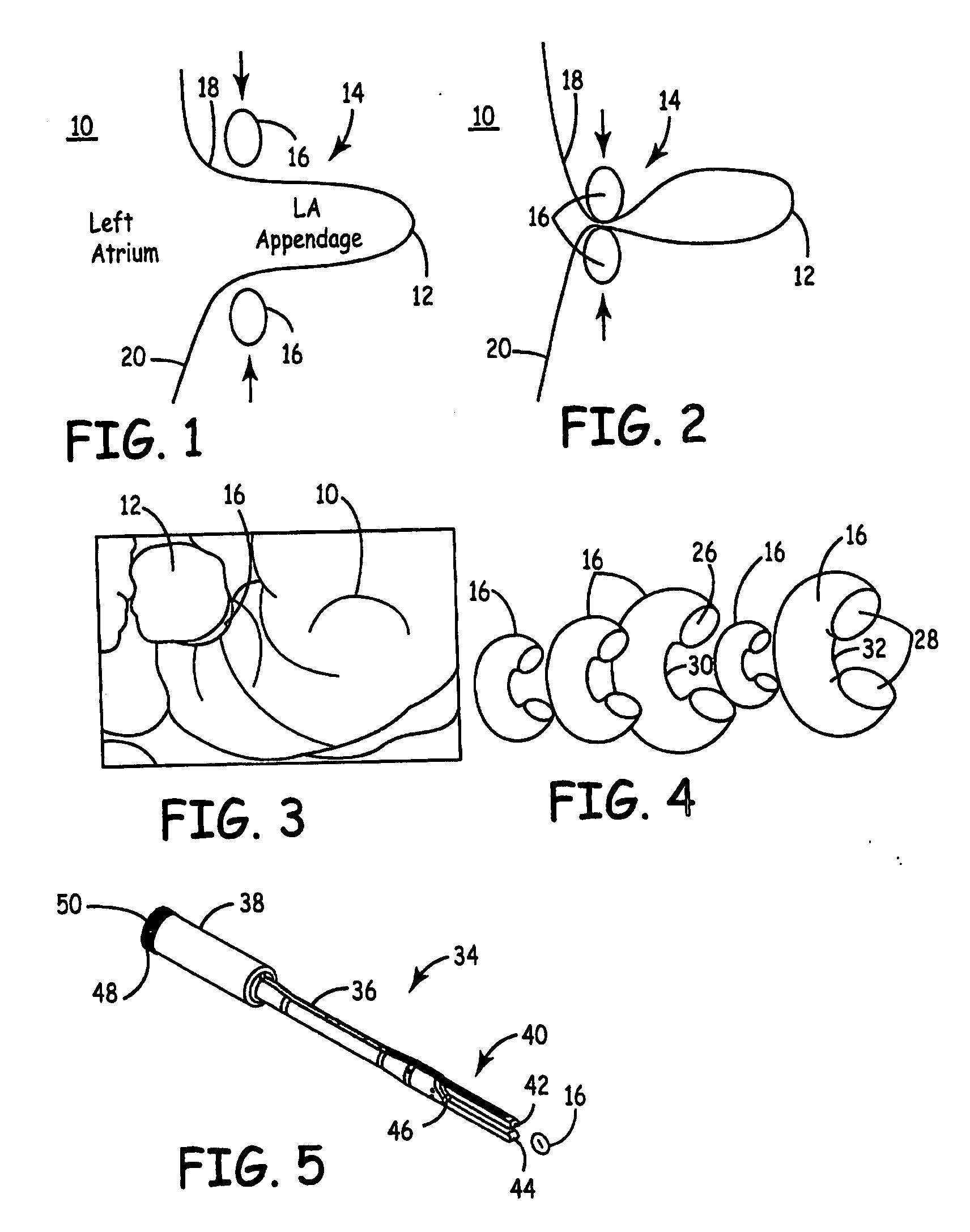 Methods and devices for occlusion of an atrial appendage