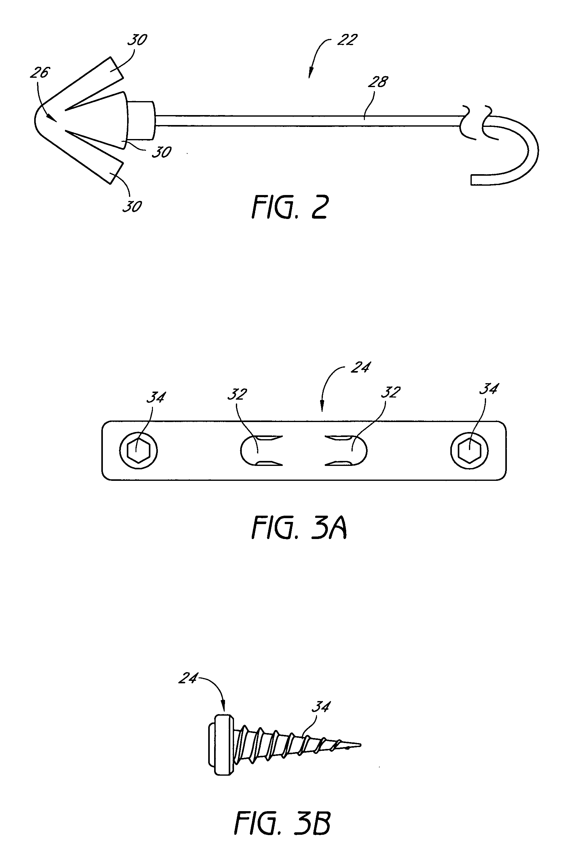 System and method for percutaneous glossoplasty