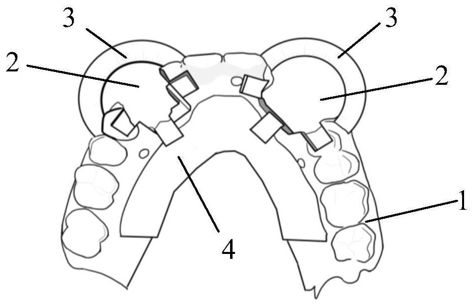 Digital all-in-one guide plate for edentulous implantation and its manufacturing method