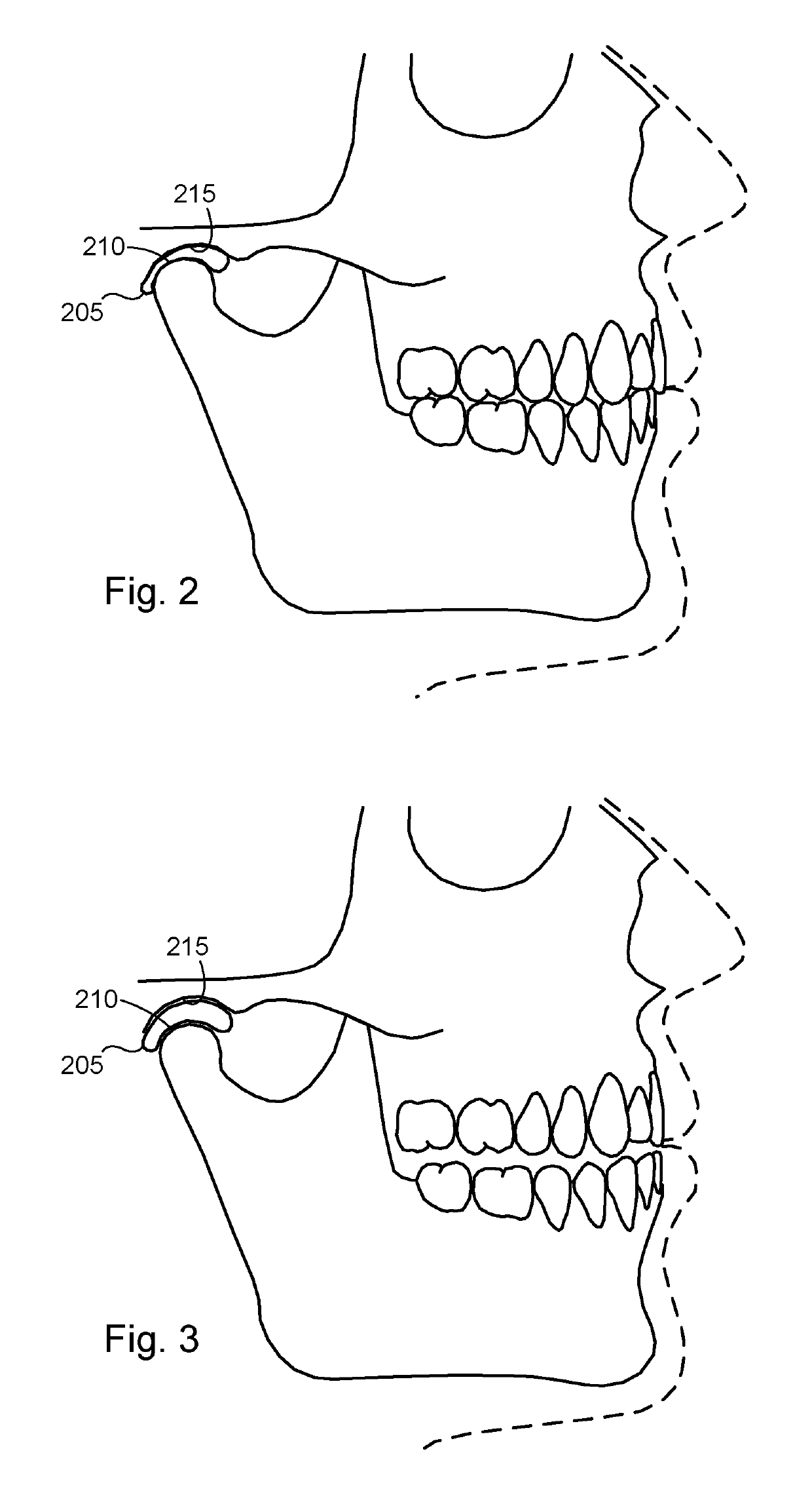 Systems and methods for determining and maintaining an orthopedically optimized Cranio-cervical/Cranio-mandibular position