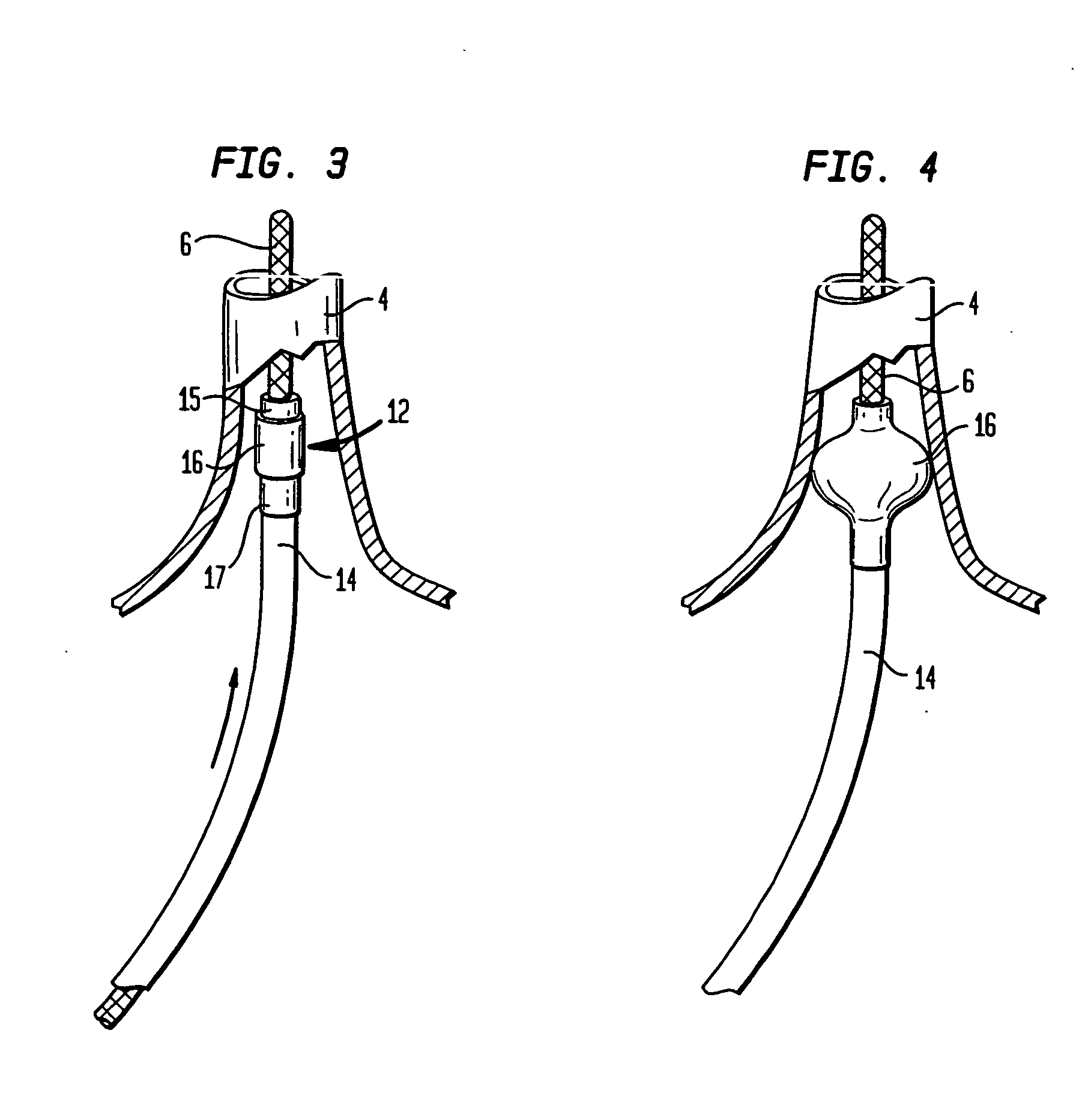 Coaxial catheter instruments for ablation with radiant energy