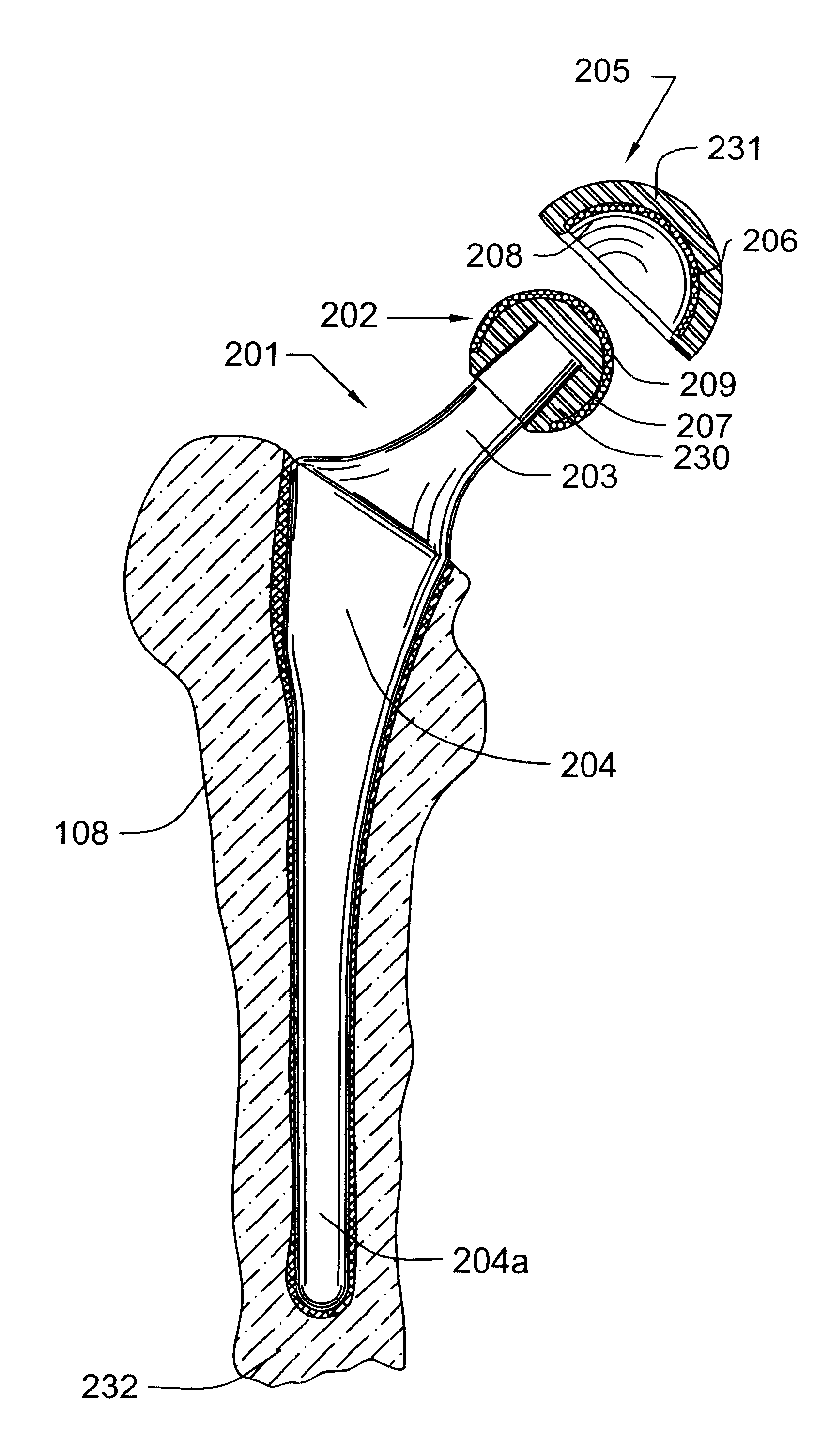 Prosthetic hip joint having at least one sintered polycrystalline diamond compact articulation surface and substrate surface topographical features in said polycrystalline diamond compact