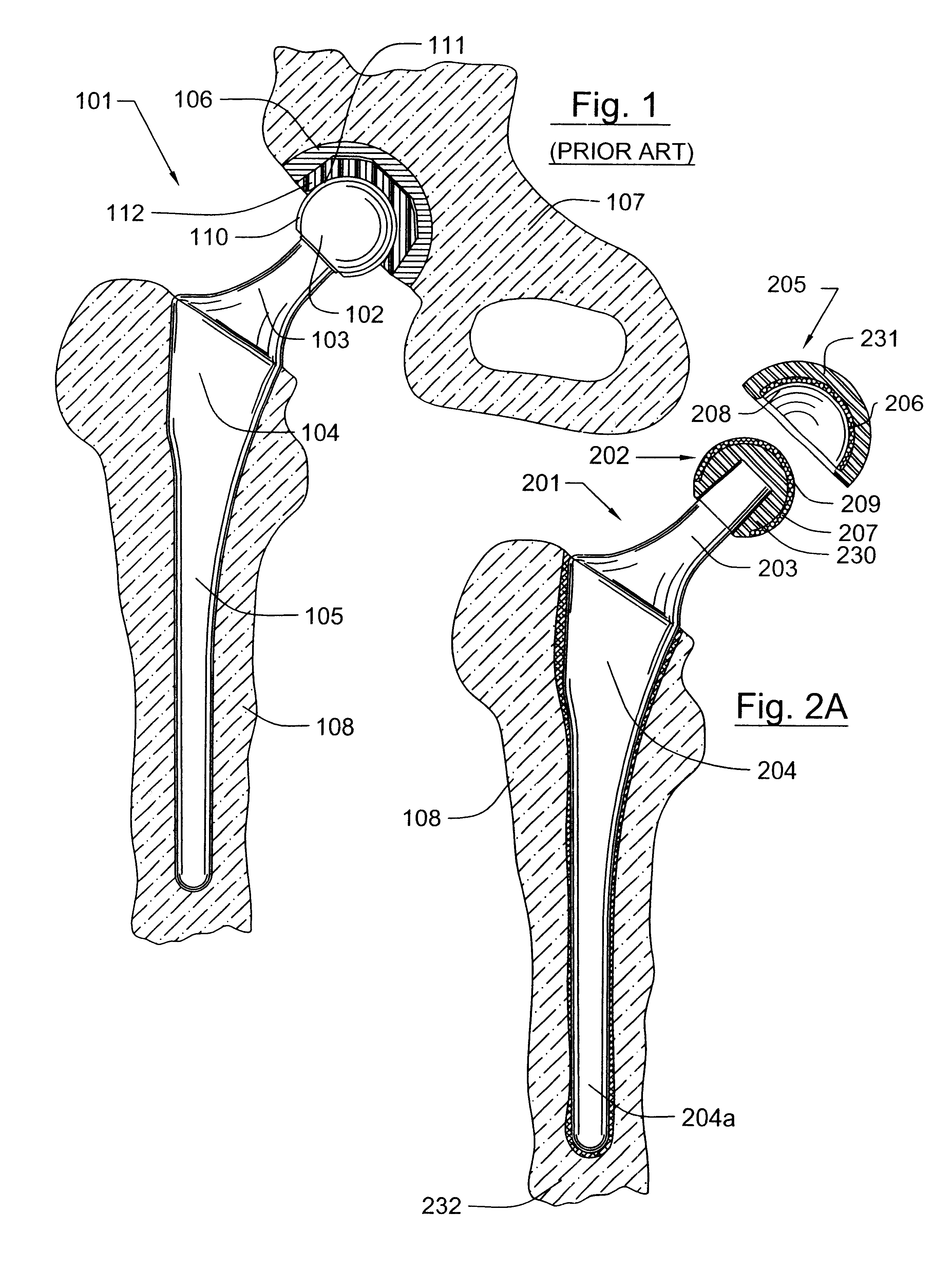 Prosthetic hip joint having at least one sintered polycrystalline diamond compact articulation surface and substrate surface topographical features in said polycrystalline diamond compact