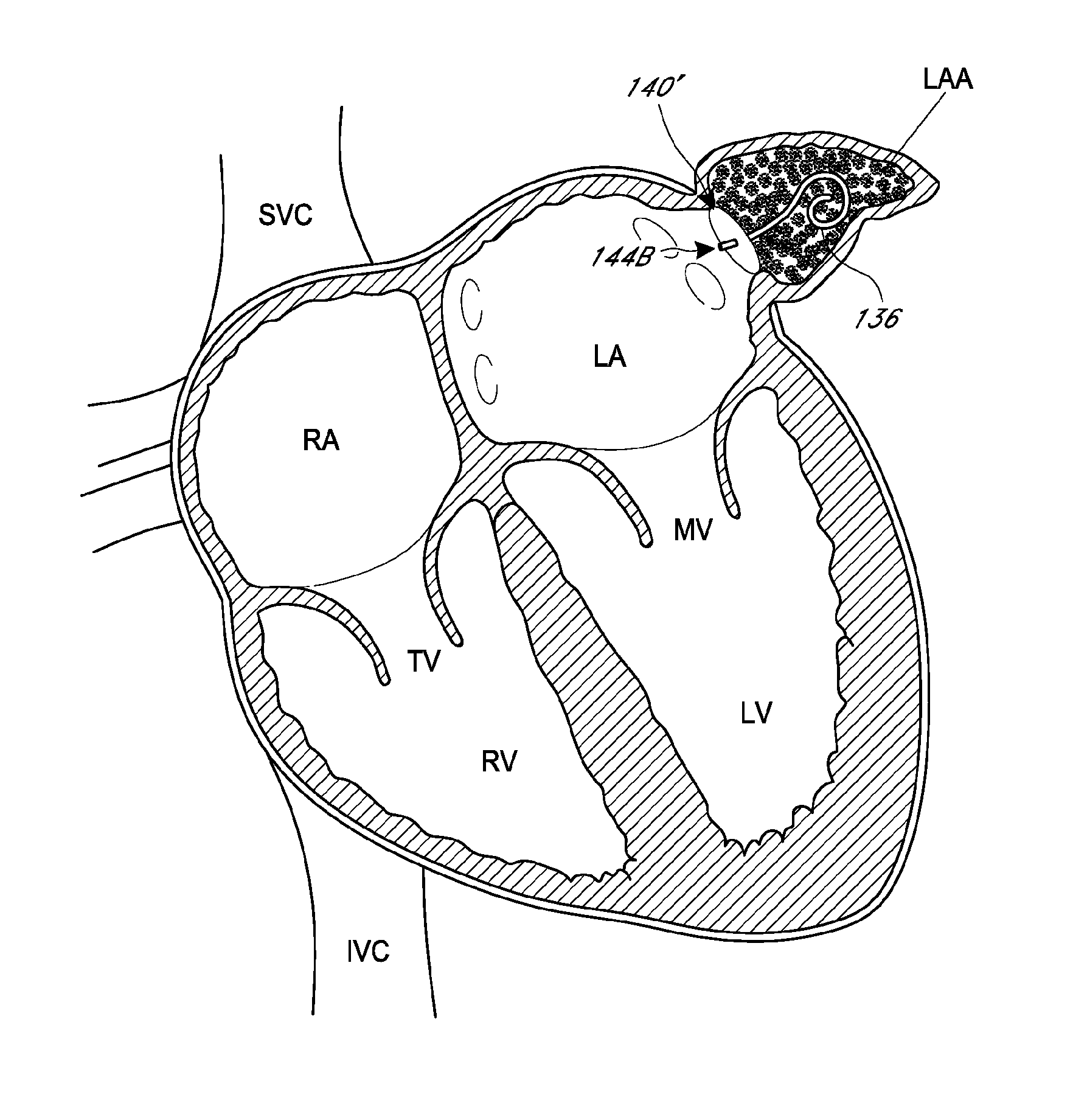 Left atrial appendage occlusion devices and methods