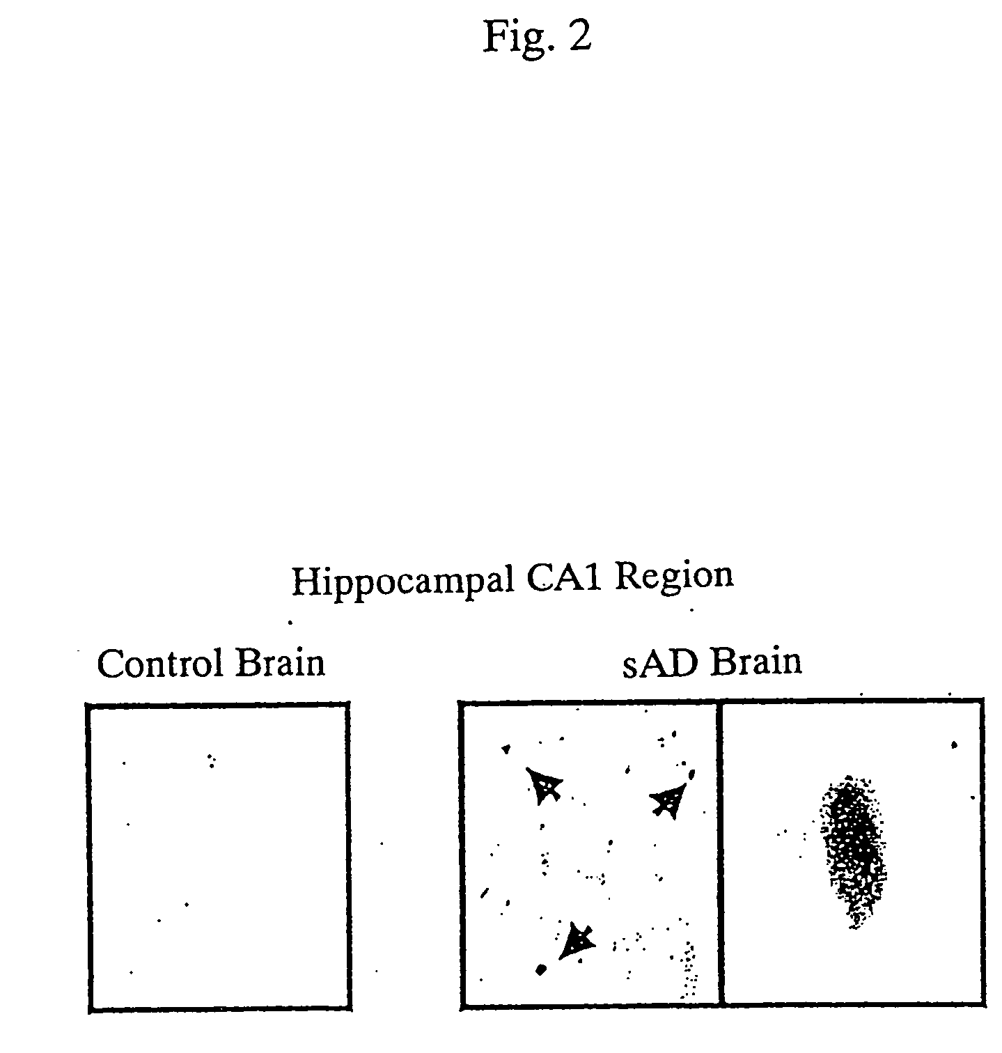 Nucleic acid participating in the formation of presenilin-2-gene exon 5-defective splicing variant