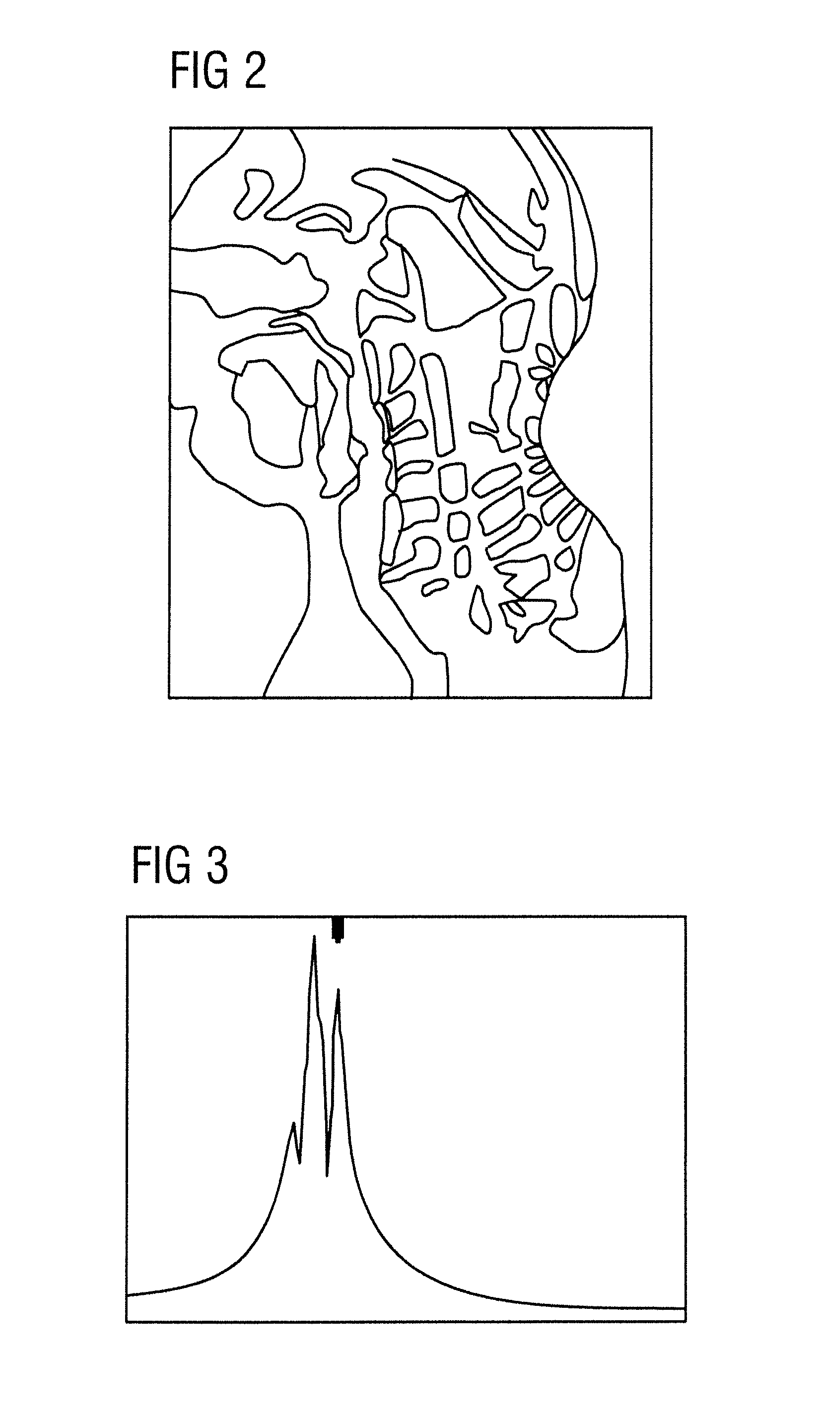 Method for imaging in magnetic resonance tomography with spectral fat saturation or spectral water excitation