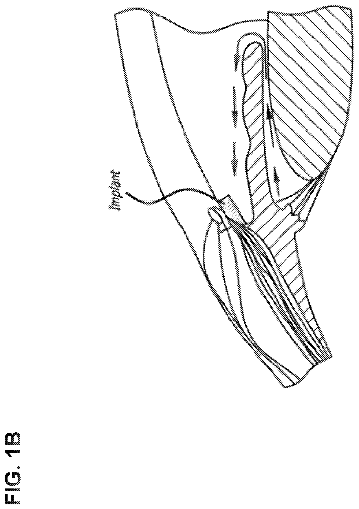 Glaucoma Treatment Via Intracameral Ocular Implants