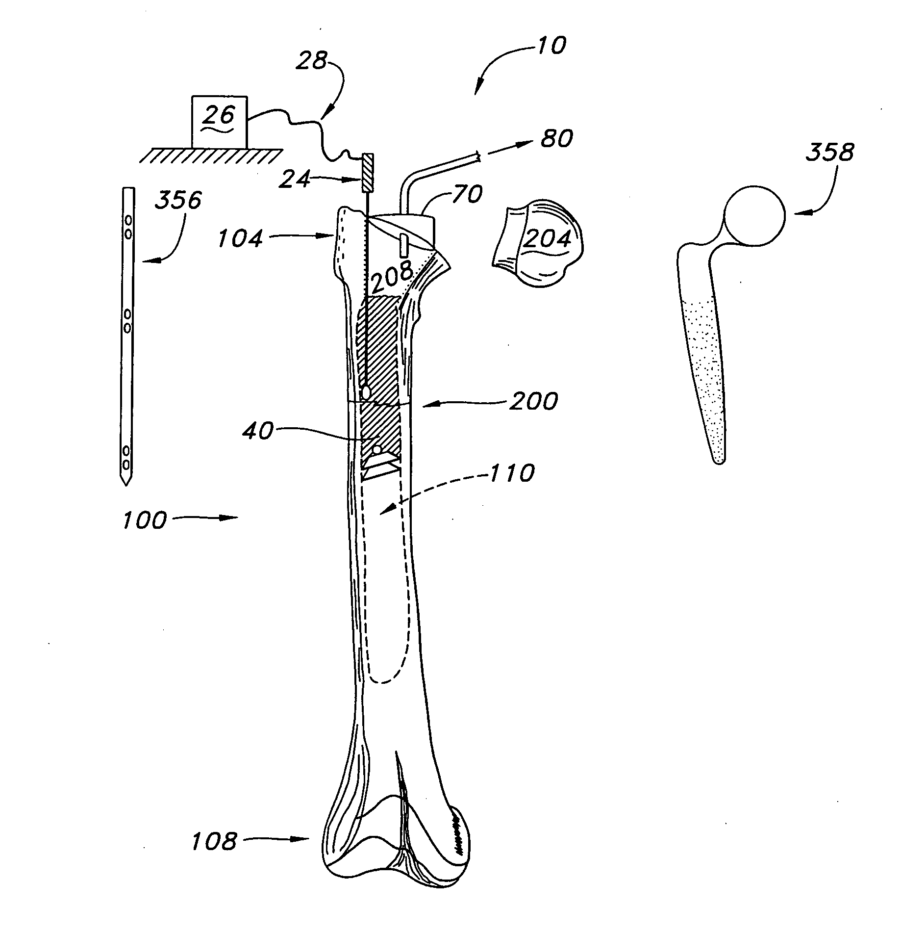 Method and apparatus for strengthening the biomechanical properties of implants