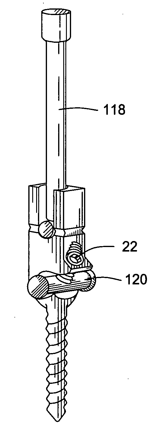 Pedicle Screw